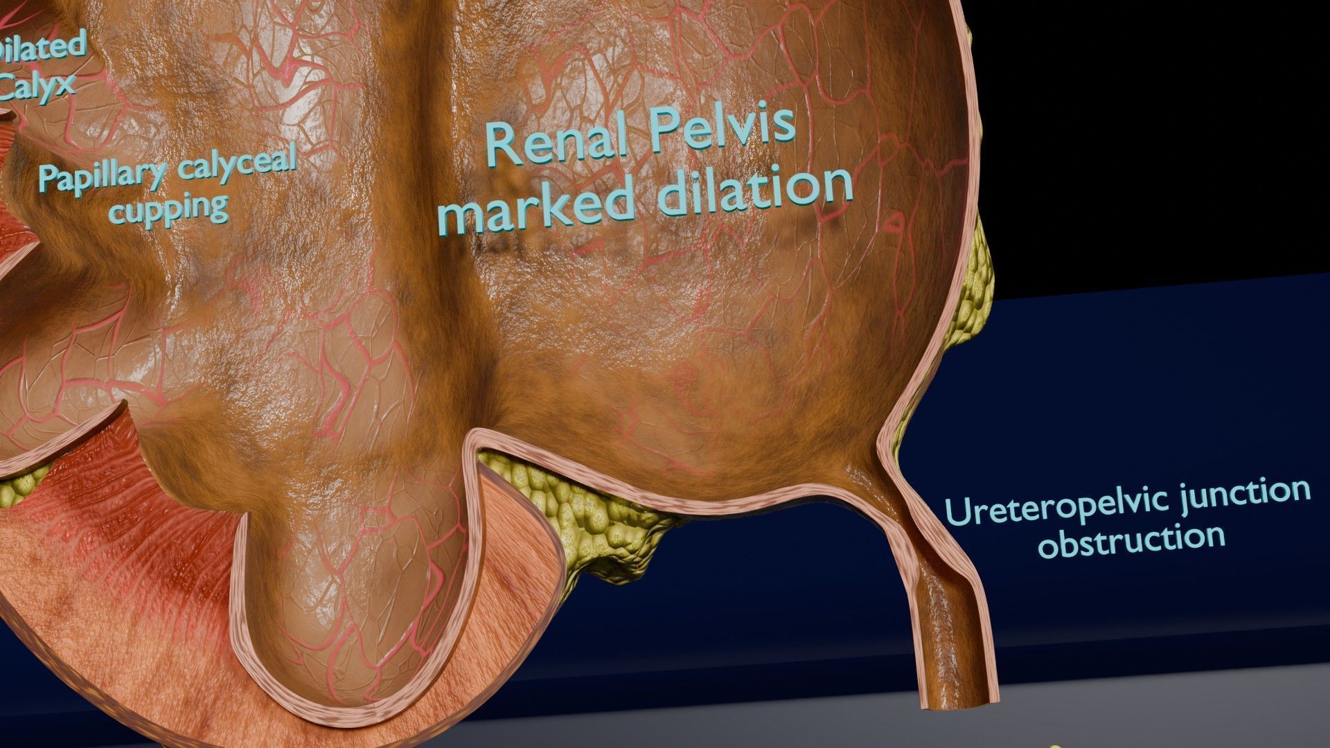 Hydronephrosis marked kidney renal Low-poly 3D model_14
