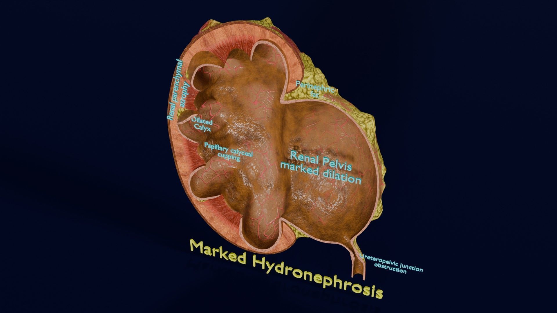 Hydronephrosis marked kidney renal Low-poly 3D model_56