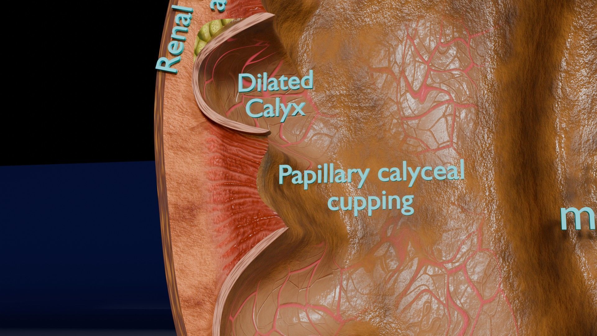 Hydronephrosis marked kidney renal Low-poly 3D model_8