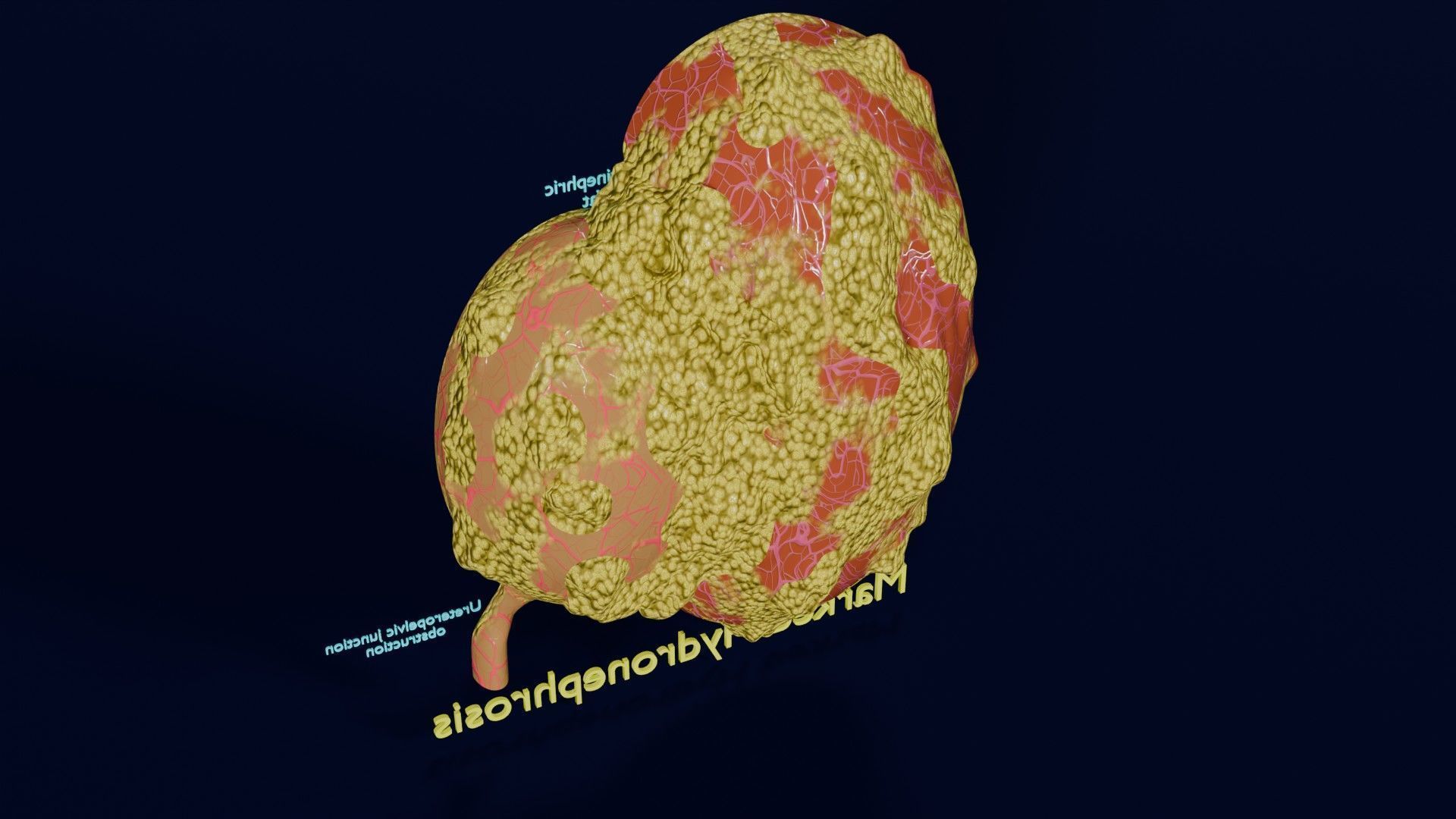 Hydronephrosis marked kidney renal Low-poly 3D model_40