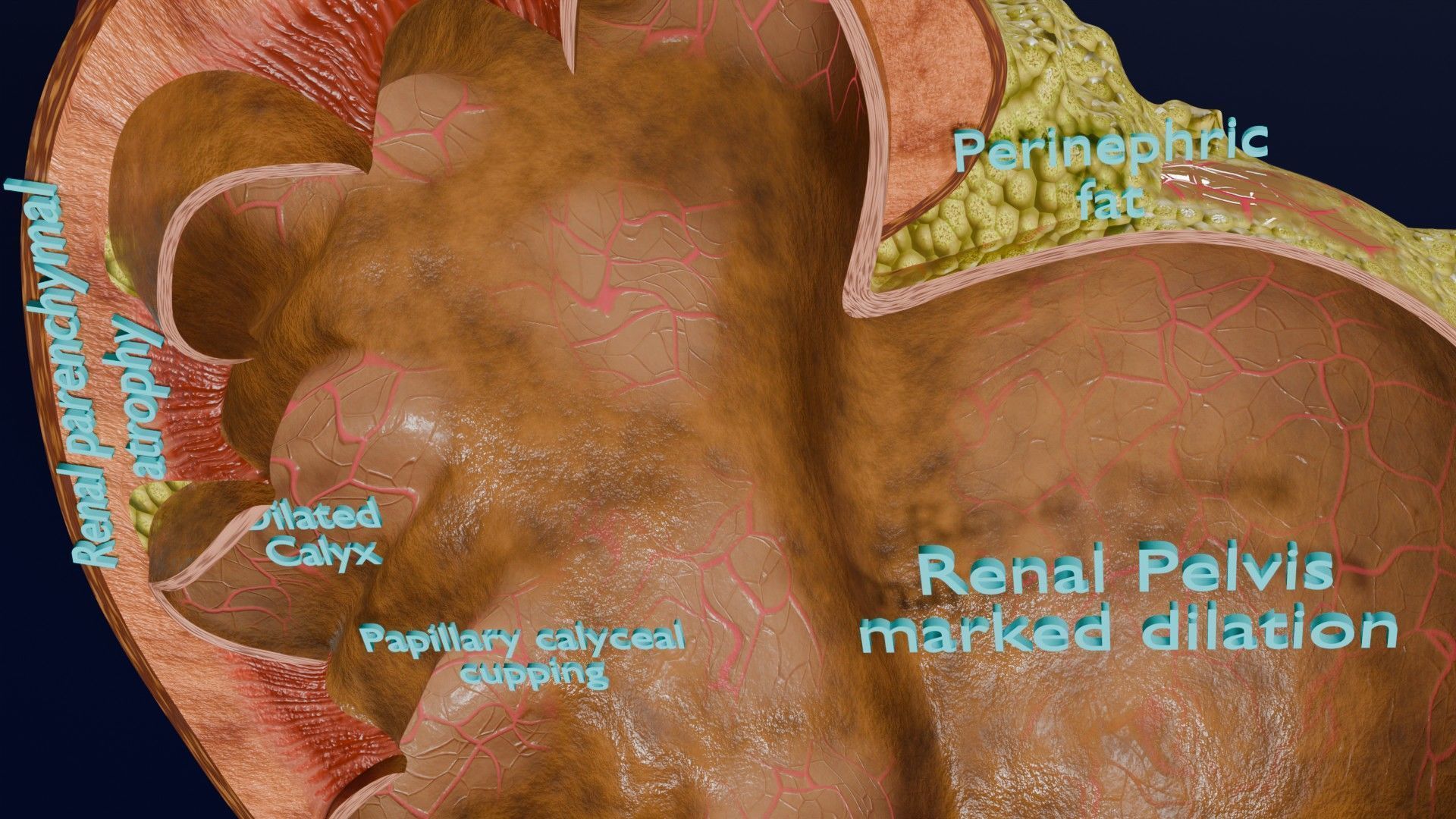 Hydronephrosis marked kidney renal Low-poly 3D model_11