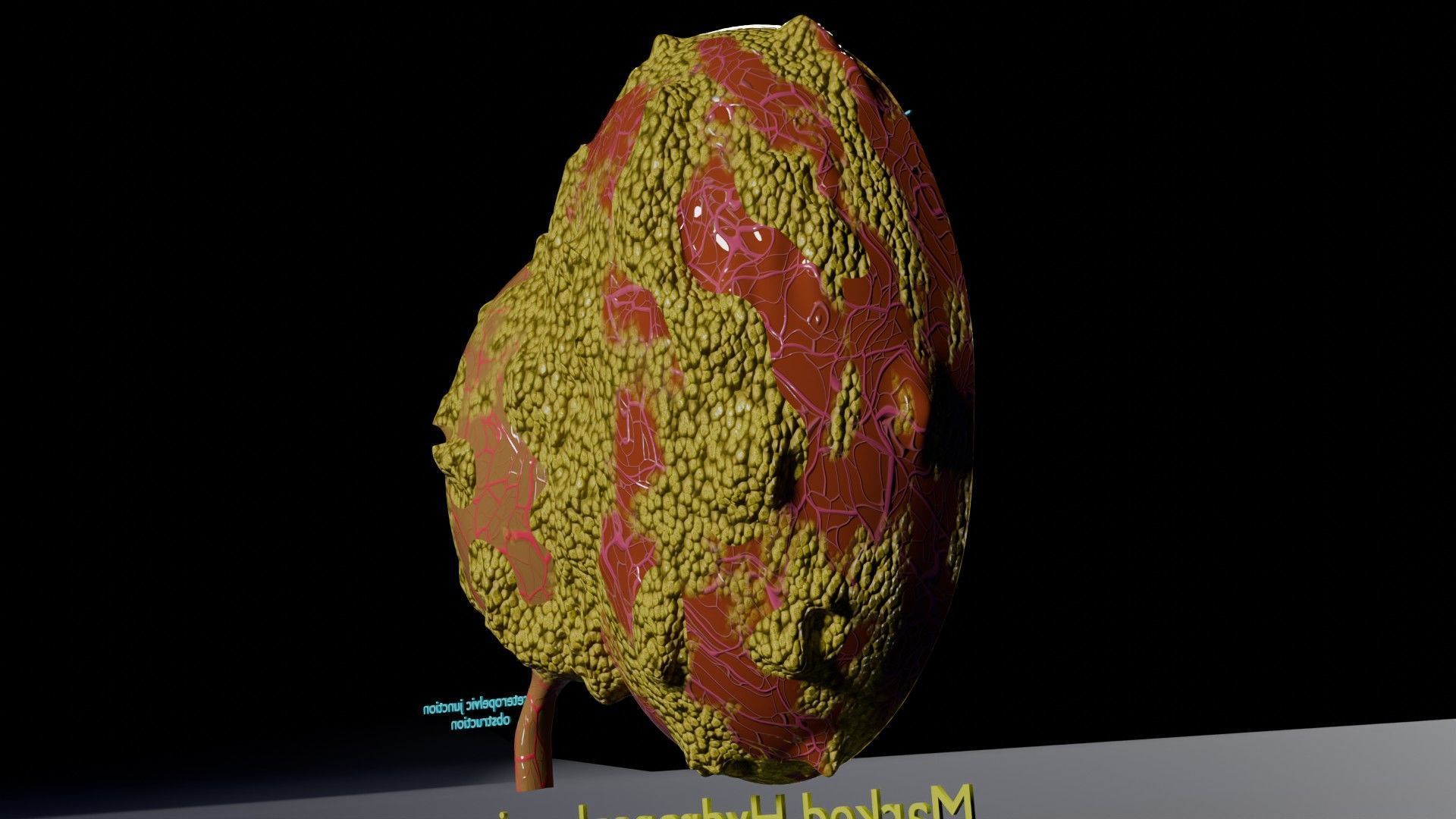 Hydronephrosis marked kidney renal Low-poly 3D model_13