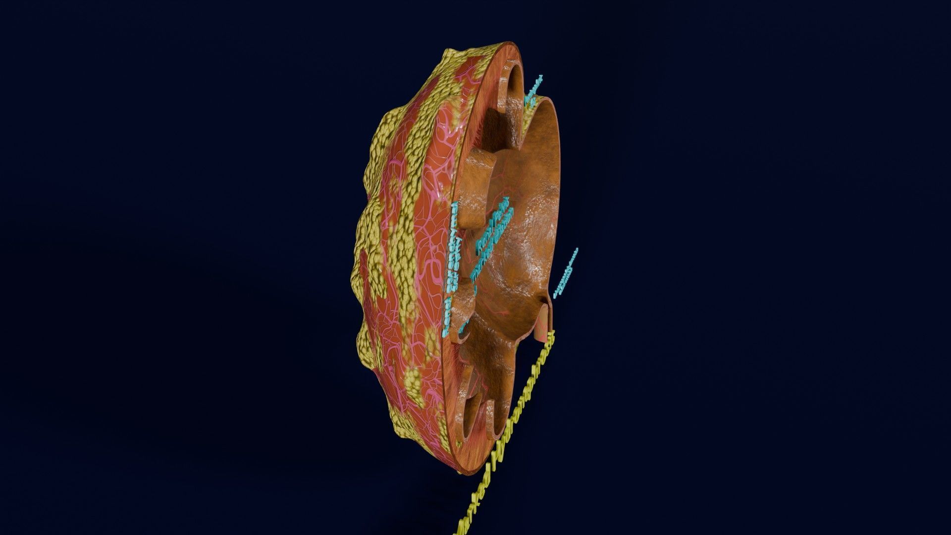 Hydronephrosis marked kidney renal Low-poly 3D model_26