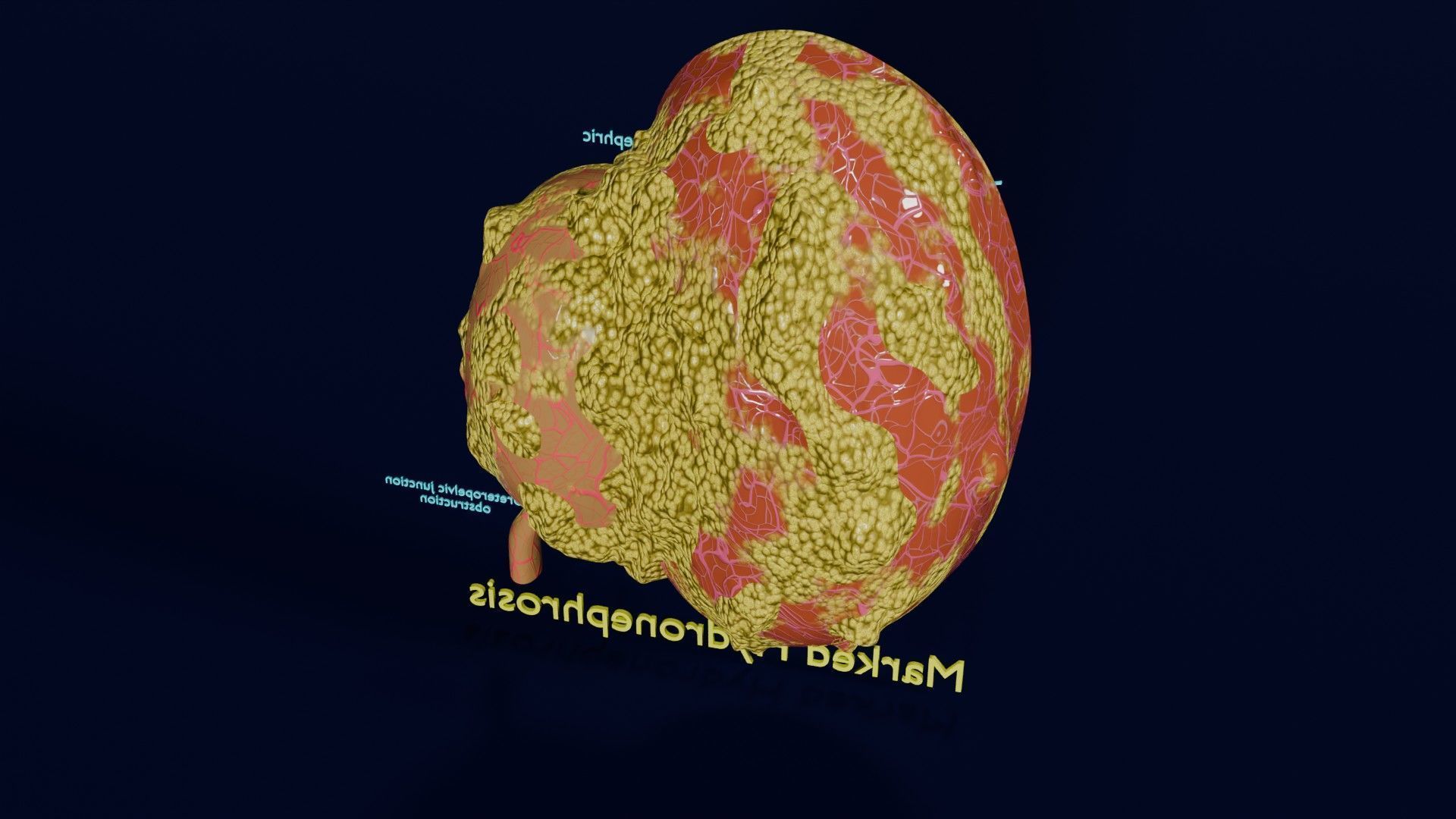 Hydronephrosis marked kidney renal Low-poly 3D model_36