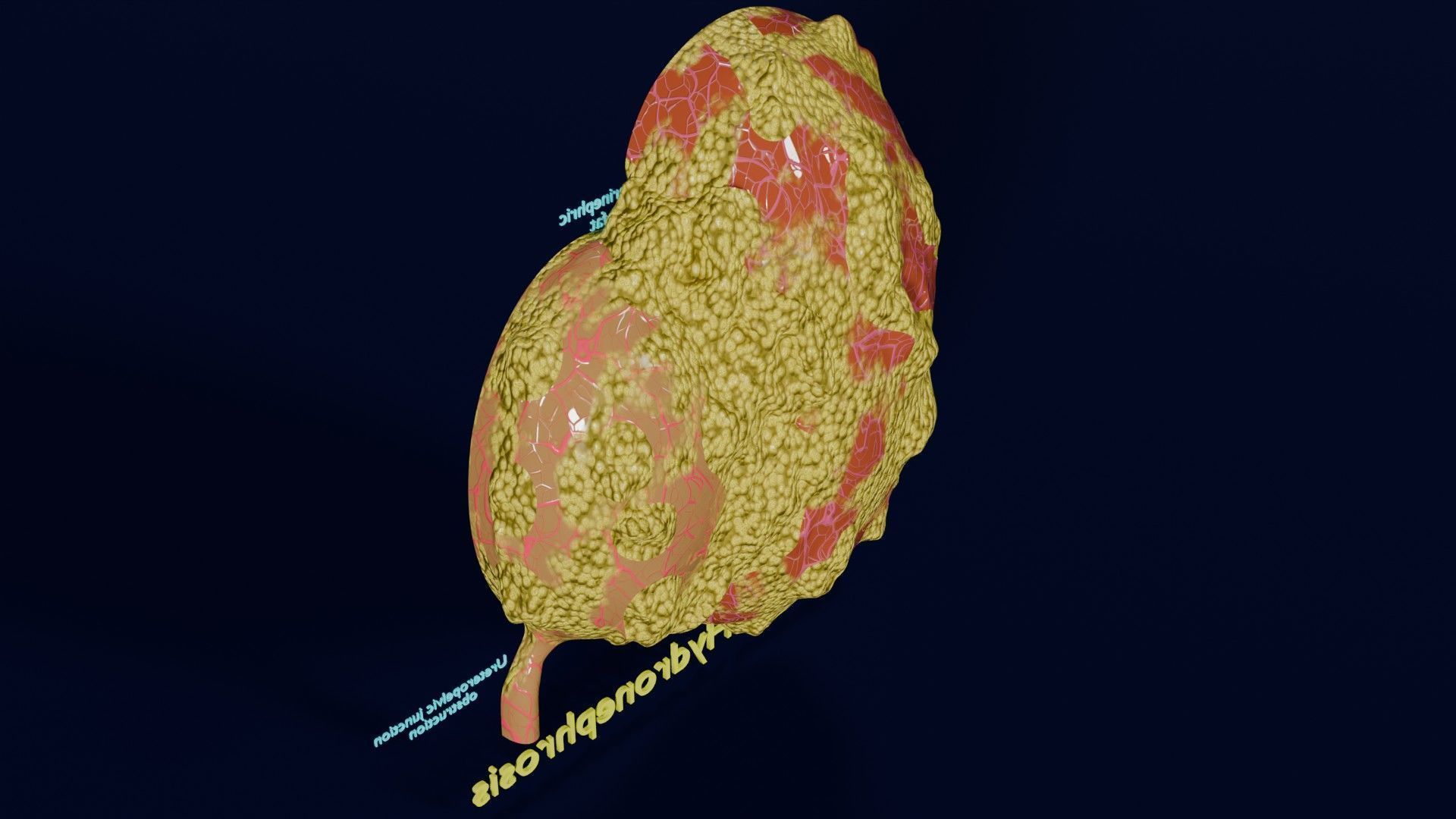 Hydronephrosis marked kidney renal Low-poly 3D model_46