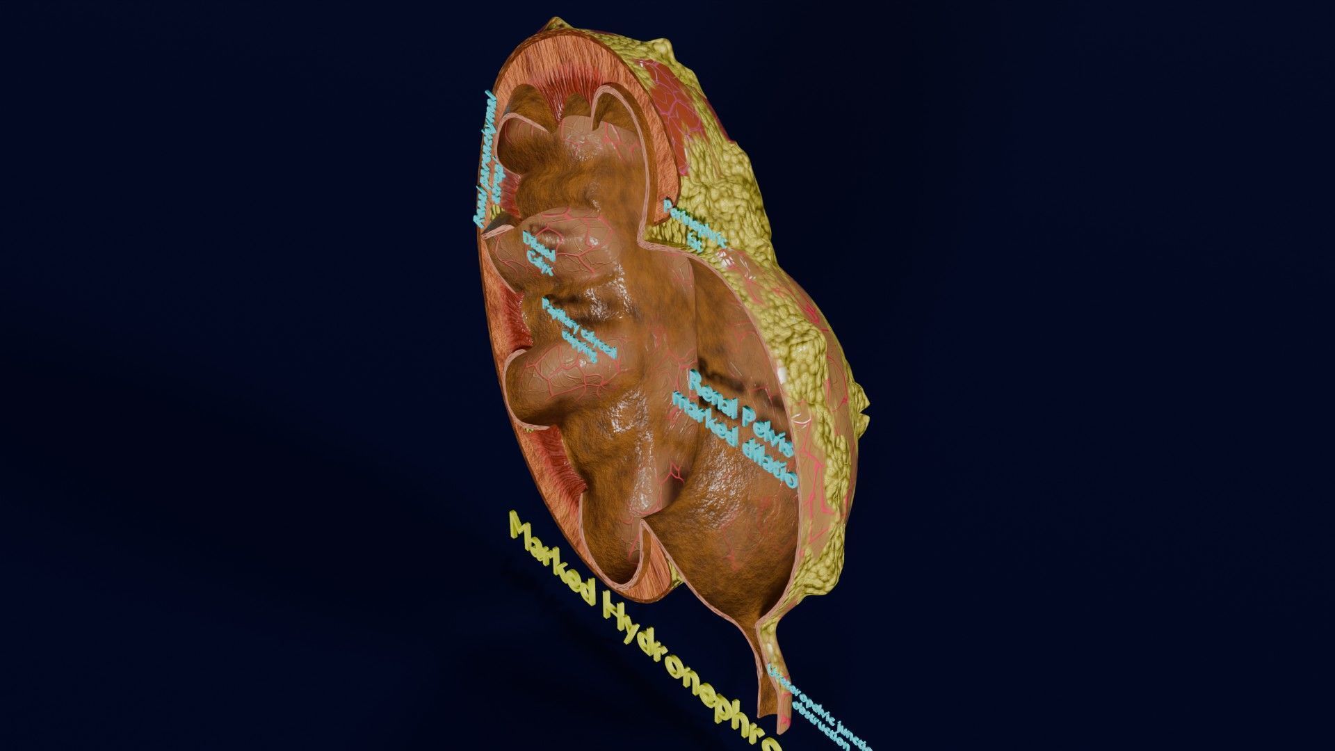 Hydronephrosis marked kidney renal Low-poly 3D model_51