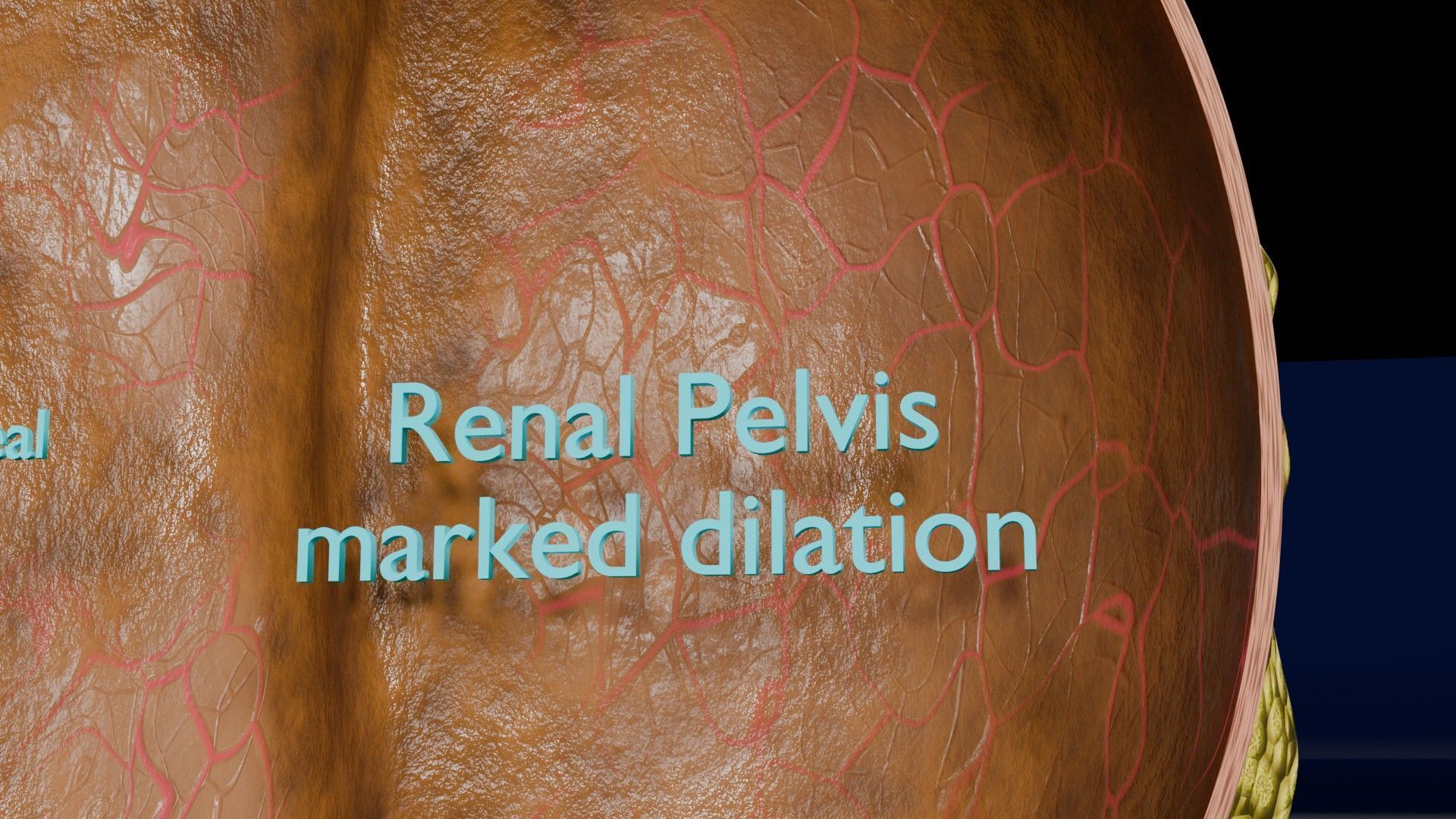 Hydronephrosis marked kidney renal Low-poly 3D model_10
