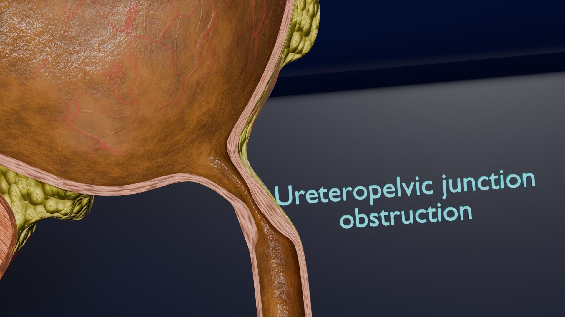 Hydronephrosis marked kidney renal Low-poly 3D model_15