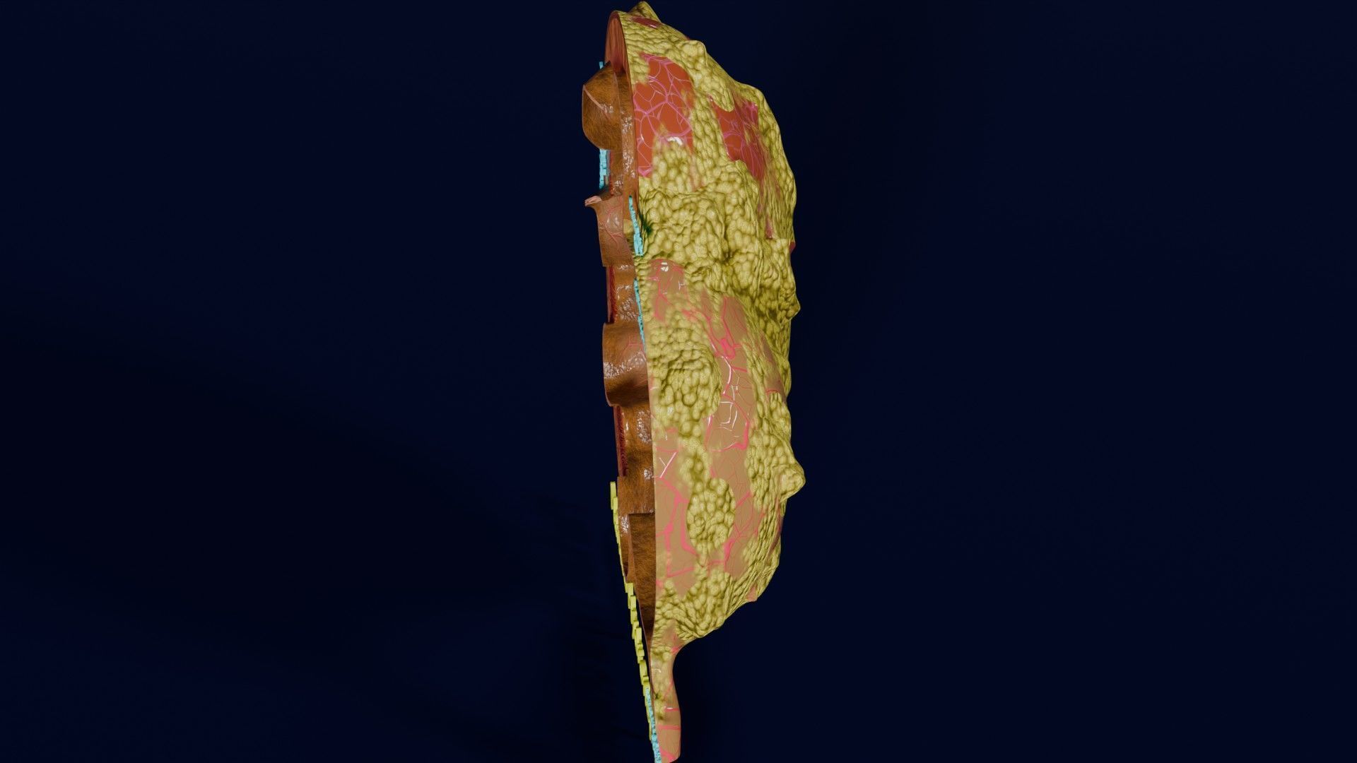 Hydronephrosis marked kidney renal Low-poly 3D model_49