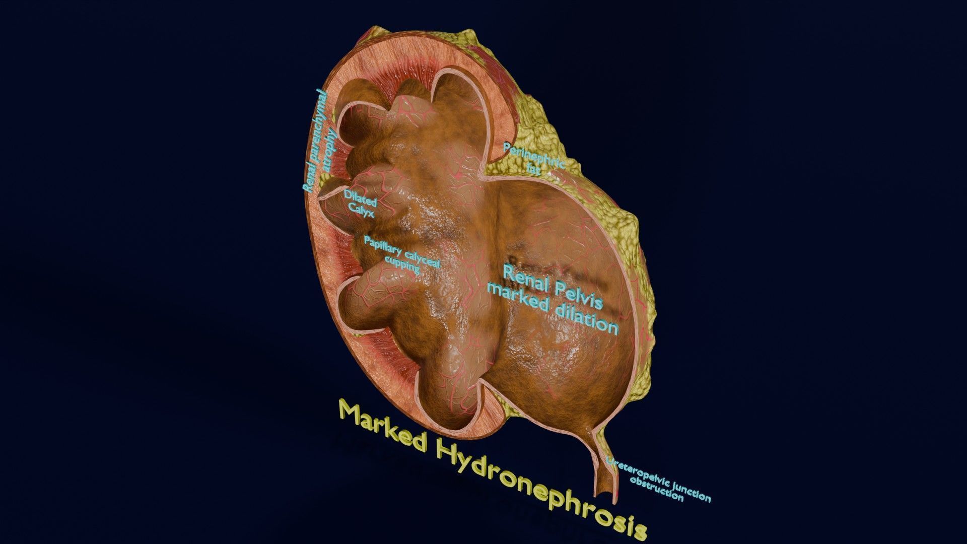 Hydronephrosis marked kidney renal Low-poly 3D model_48