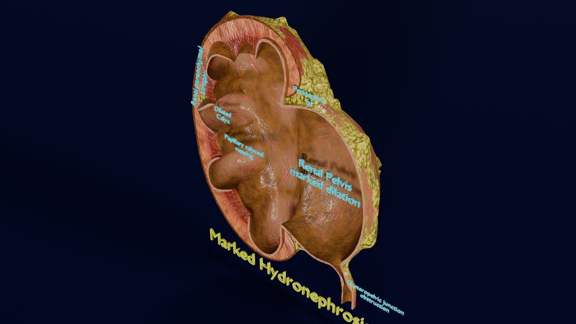 Hydronephrosis marked kidney renal Low-poly 3D model_53