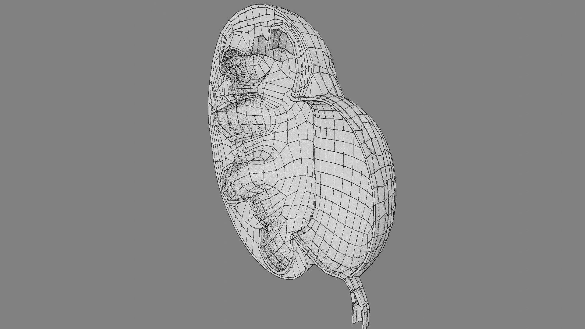 Hydronephrosis marked kidney renal Low-poly 3D model_16