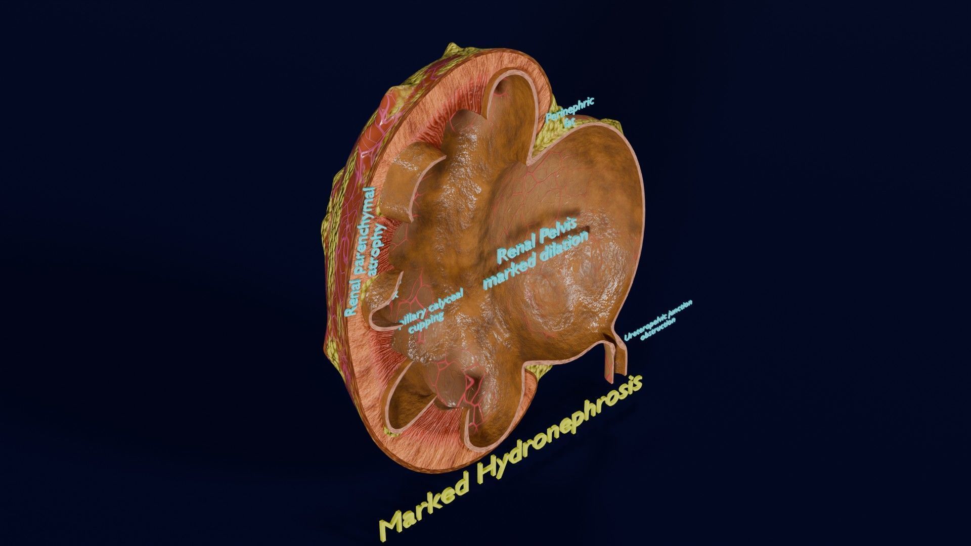 Hydronephrosis marked kidney renal Low-poly 3D model_25