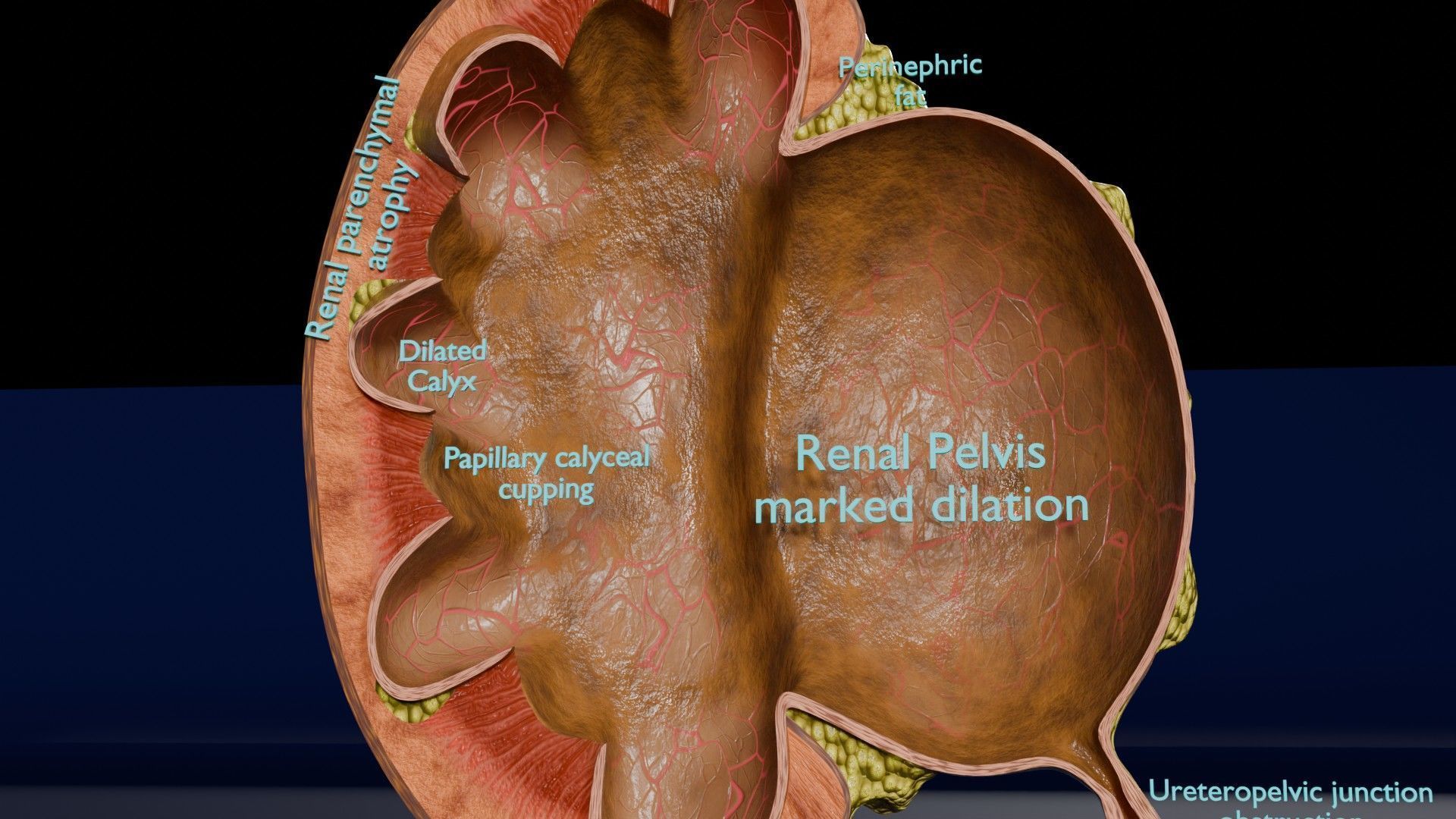 Hydronephrosis marked kidney renal Low-poly 3D model_5
