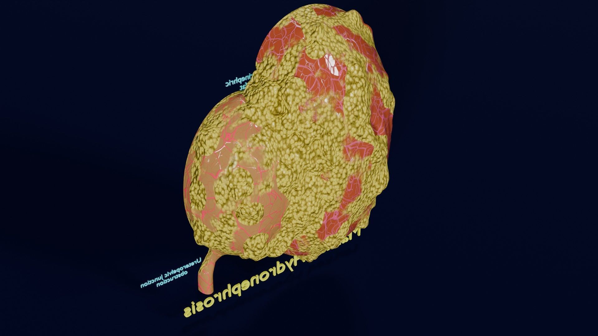 Hydronephrosis marked kidney renal Low-poly 3D model_41