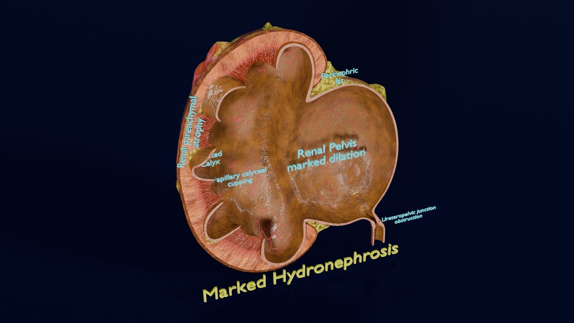 Hydronephrosis marked kidney renal Low-poly 3D model_24