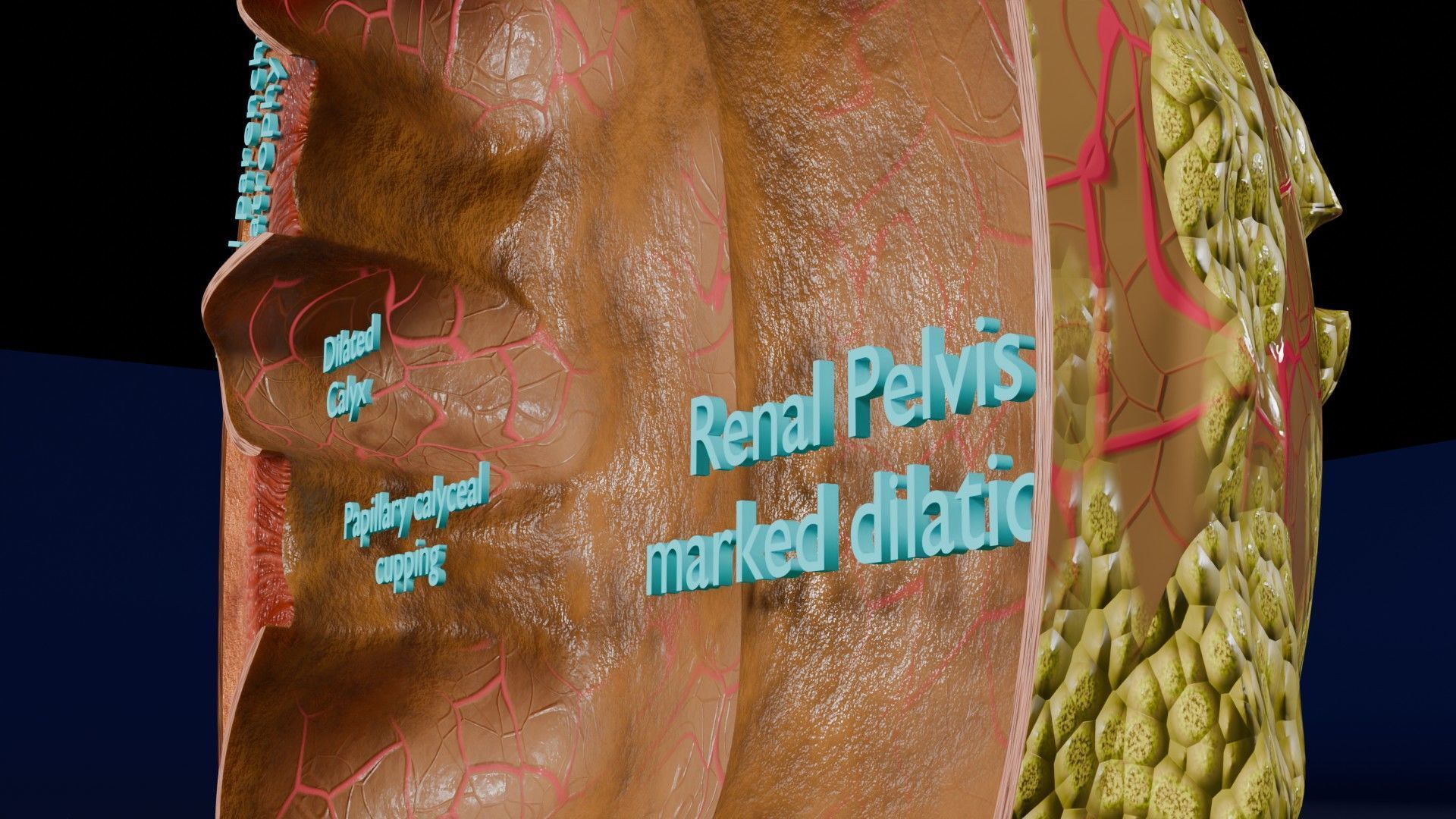 Hydronephrosis marked kidney renal Low-poly 3D model_7