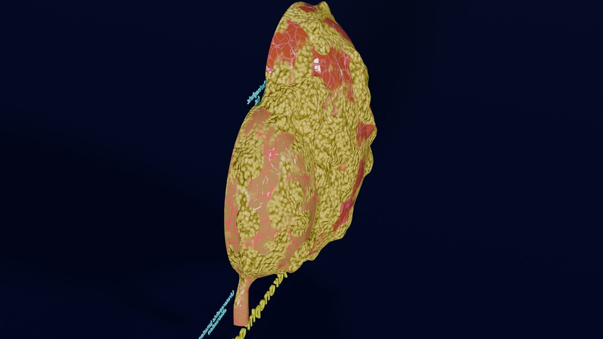 Hydronephrosis marked kidney renal Low-poly 3D model_42