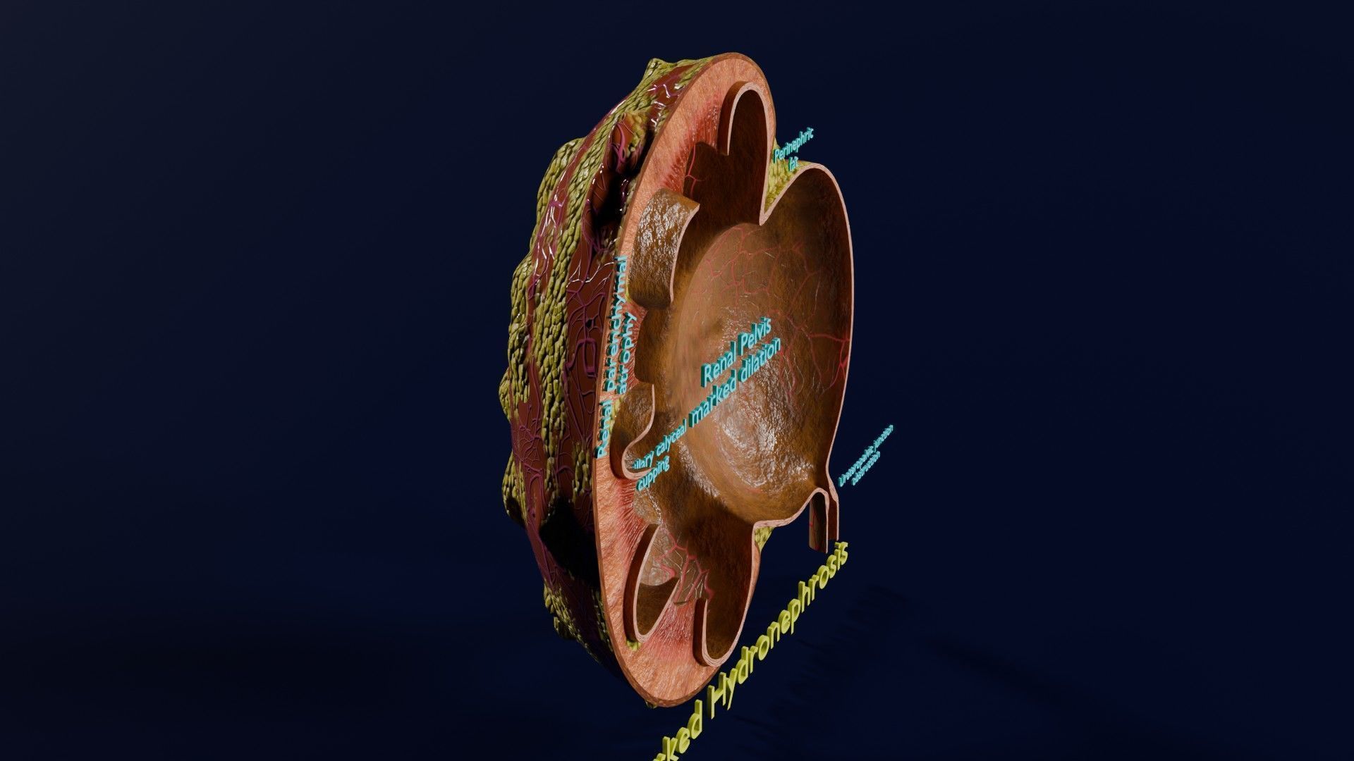 Hydronephrosis marked kidney renal Low-poly 3D model_3