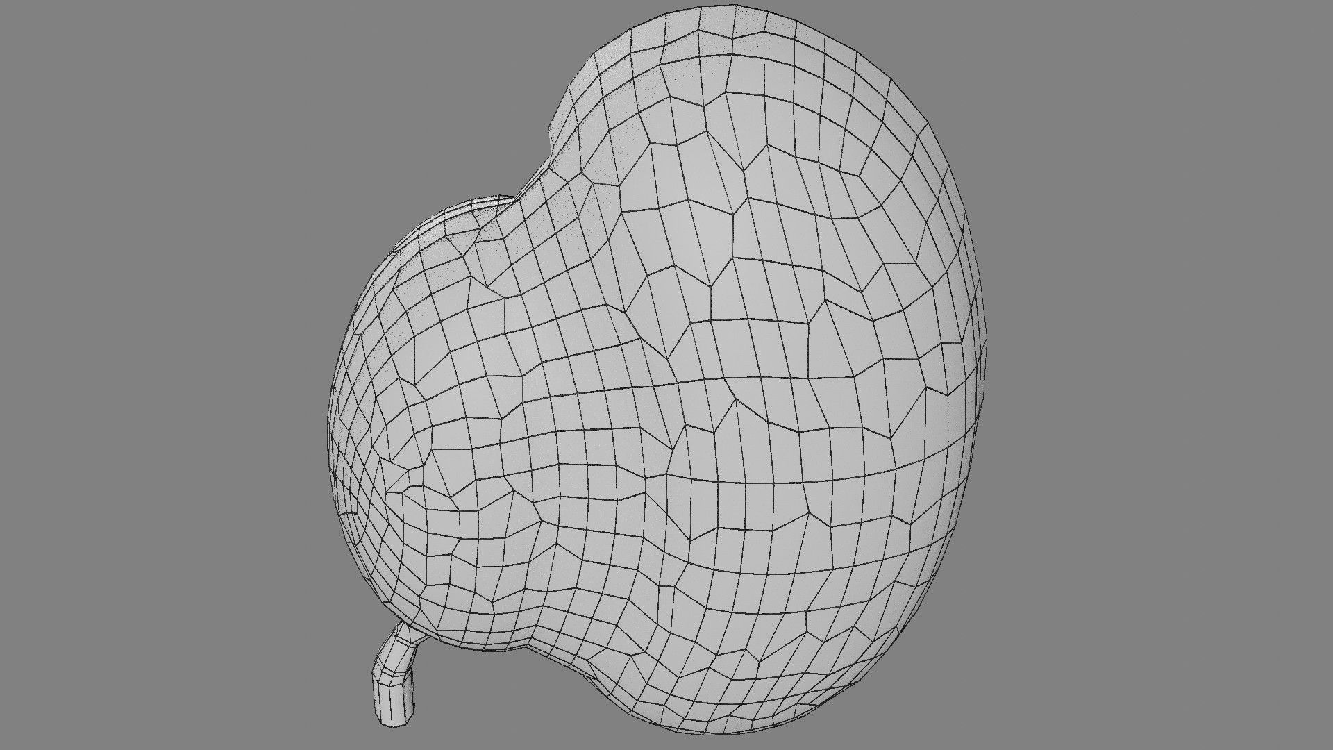 Hydronephrosis marked kidney renal Low-poly 3D model_19