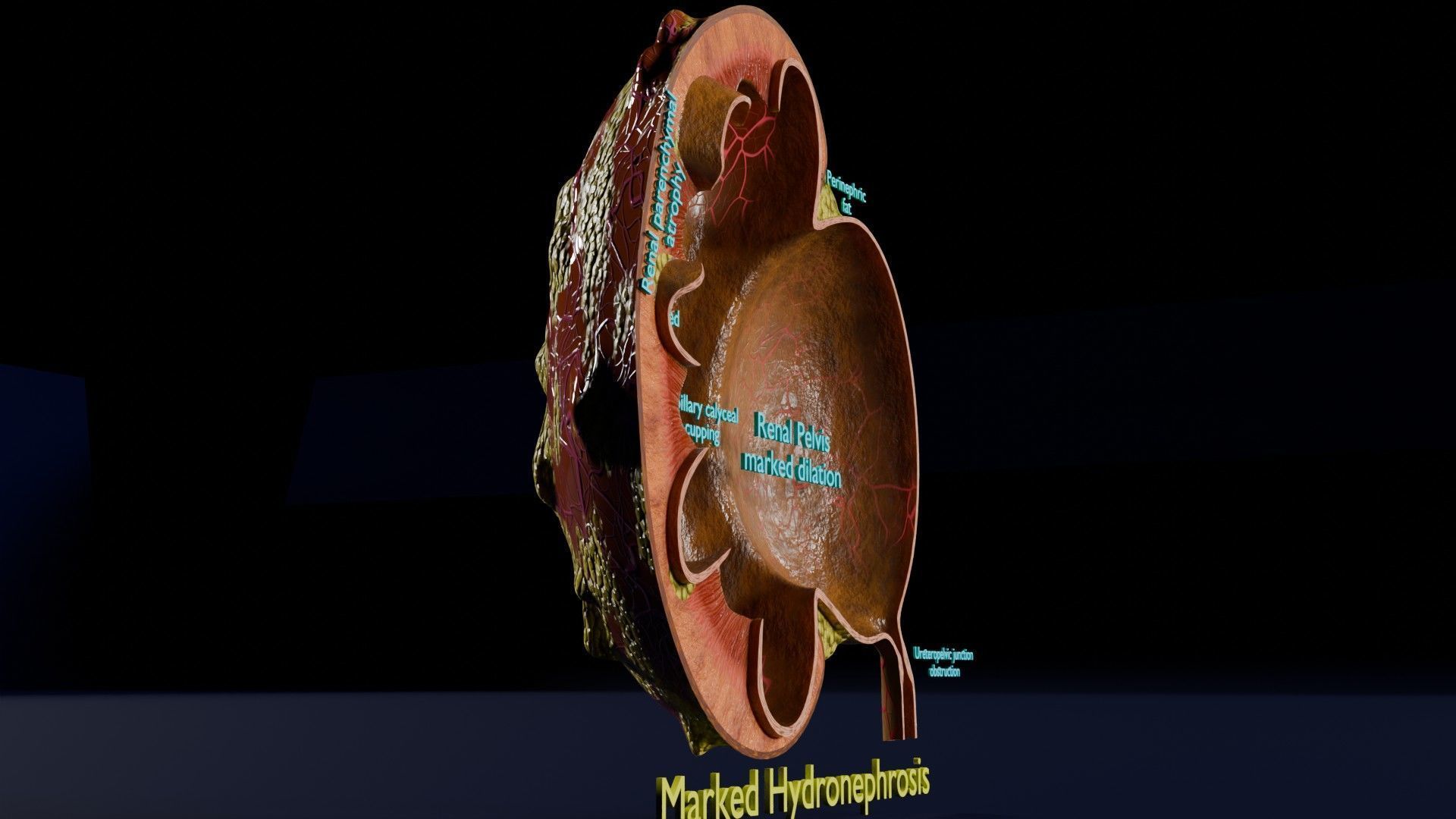 Hydronephrosis marked kidney renal Low-poly 3D model_4