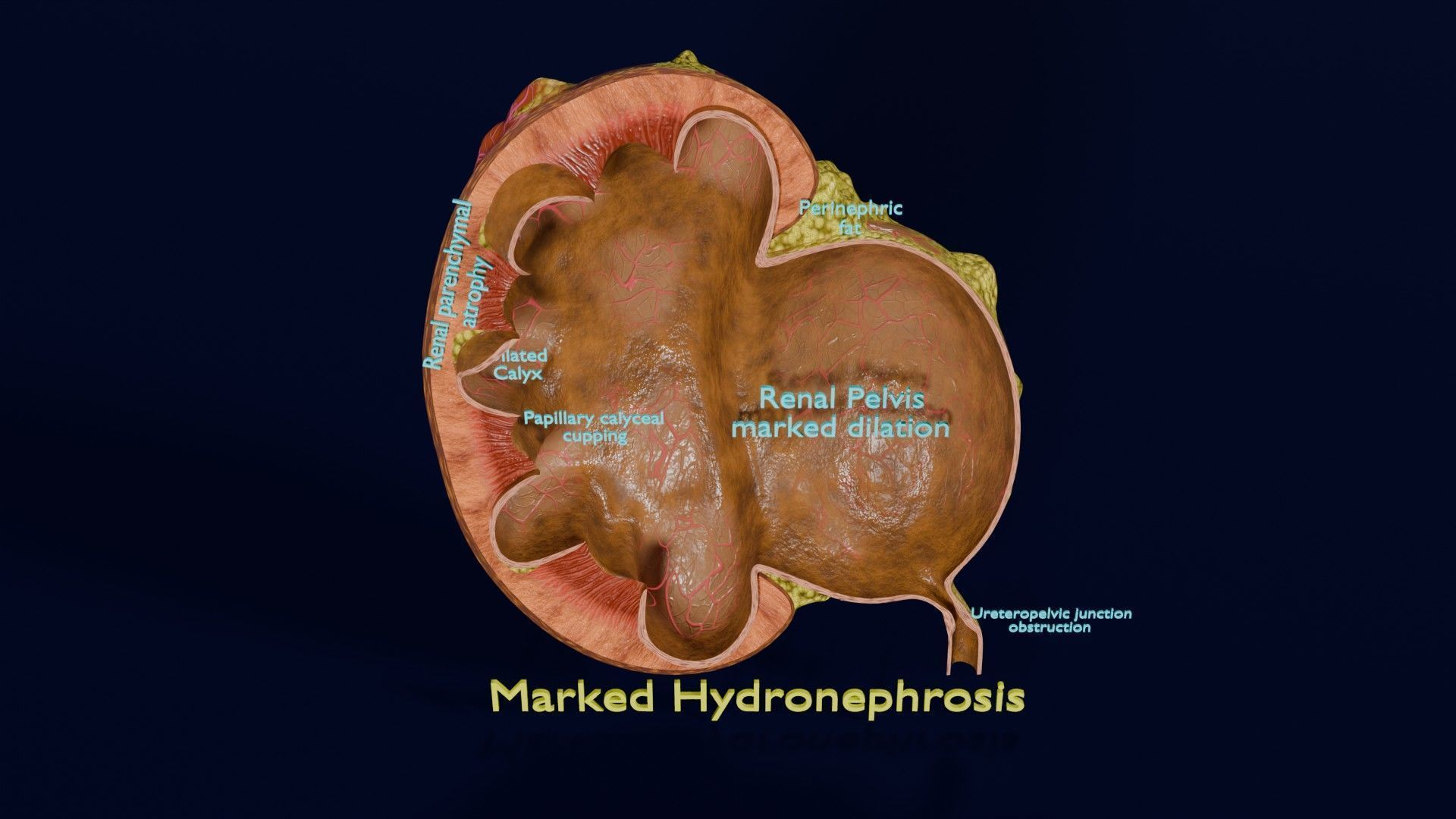Hydronephrosis marked kidney renal Low-poly 3D model_21