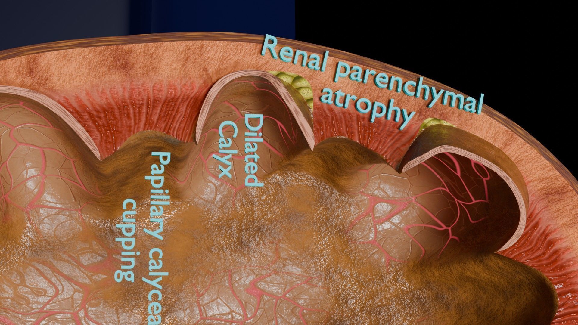 Hydronephrosis marked kidney renal Low-poly 3D model_9