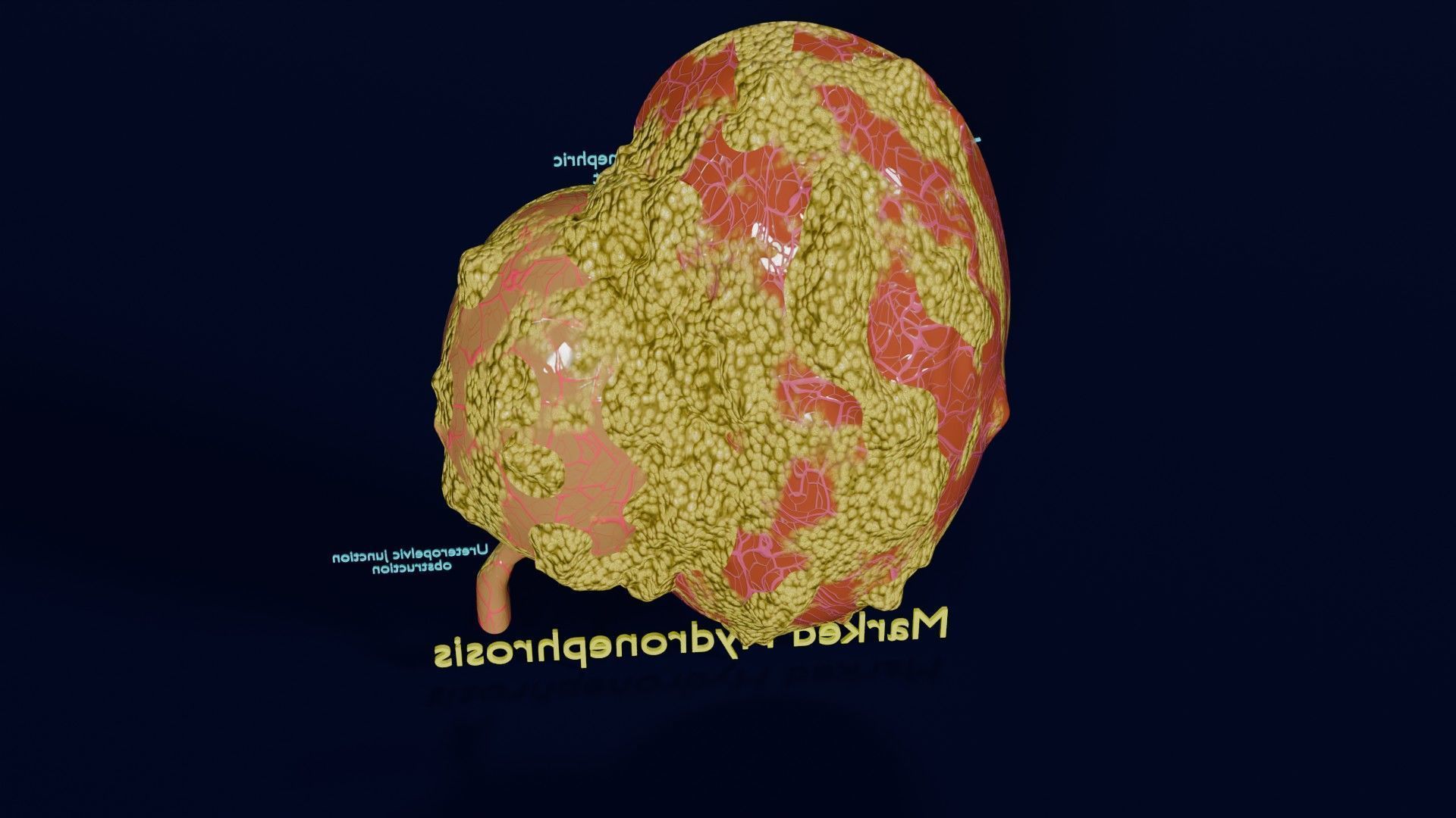 Hydronephrosis marked kidney renal Low-poly 3D model_39