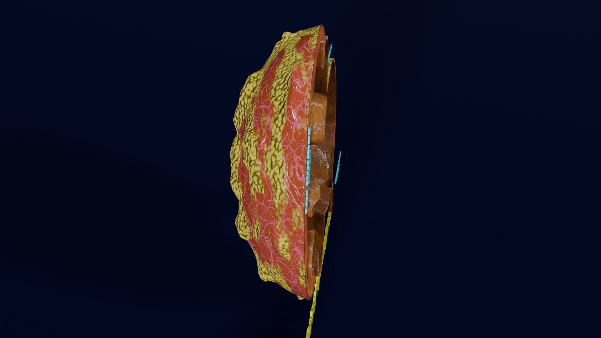 Hydronephrosis marked kidney renal Low-poly 3D model_29