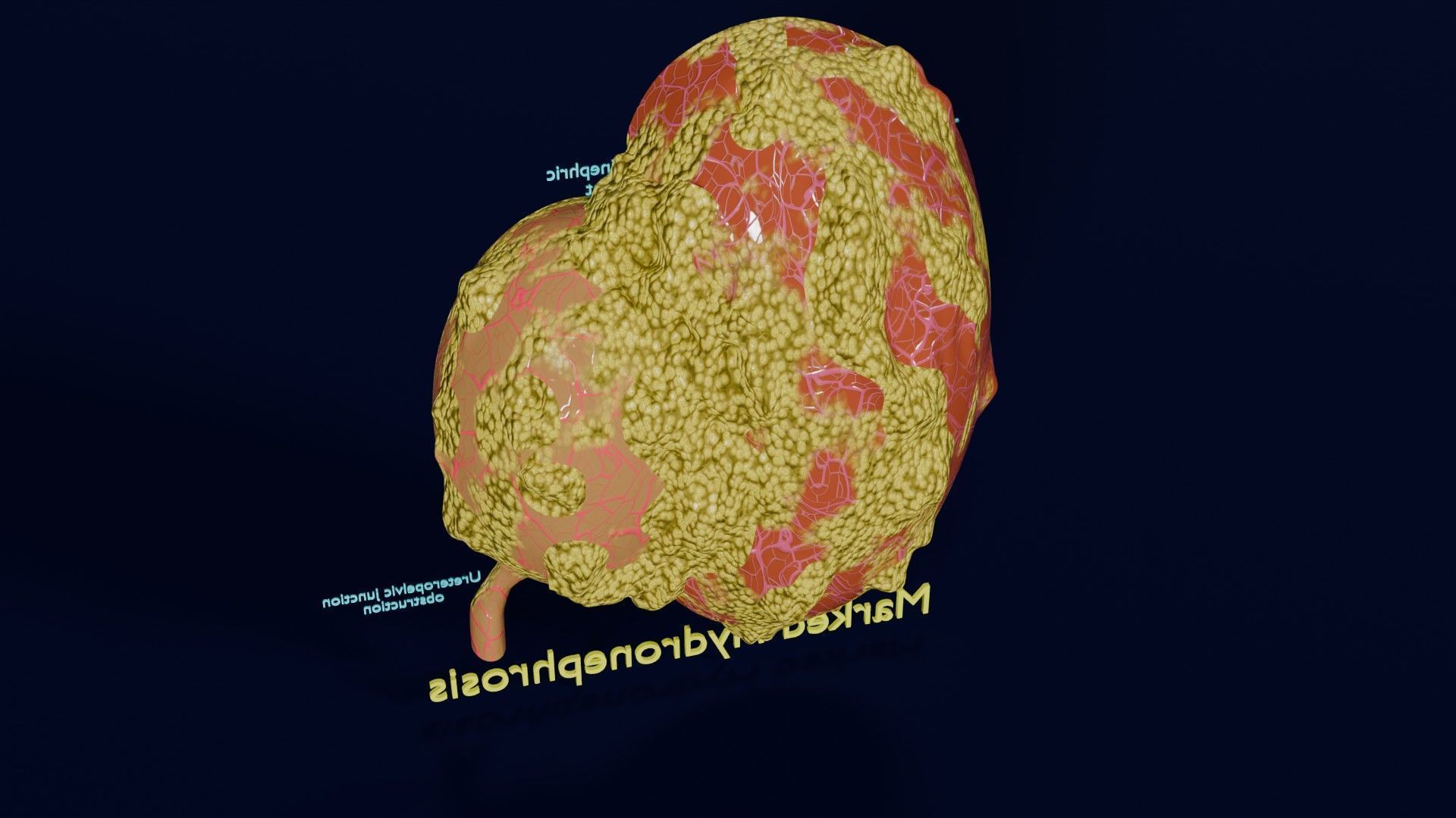 Hydronephrosis marked kidney renal Low-poly 3D model_38