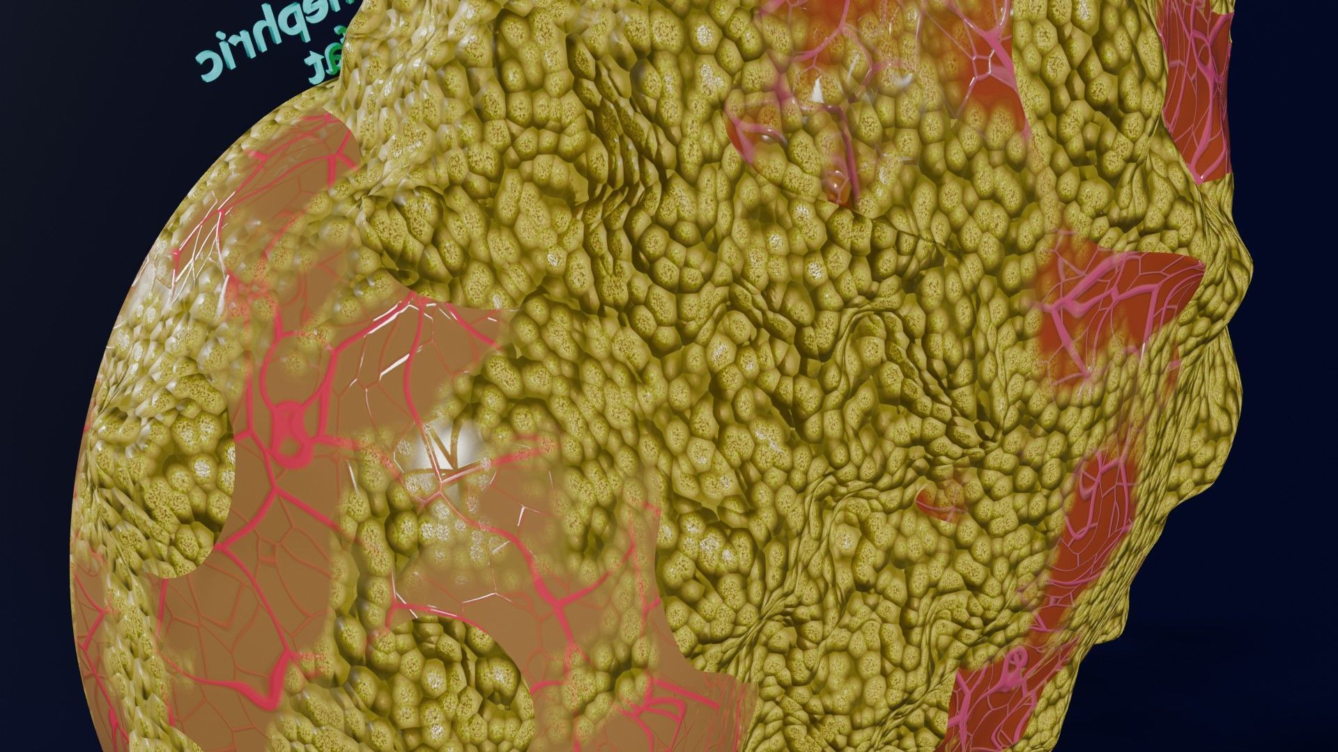 Hydronephrosis marked kidney renal Low-poly 3D model_12