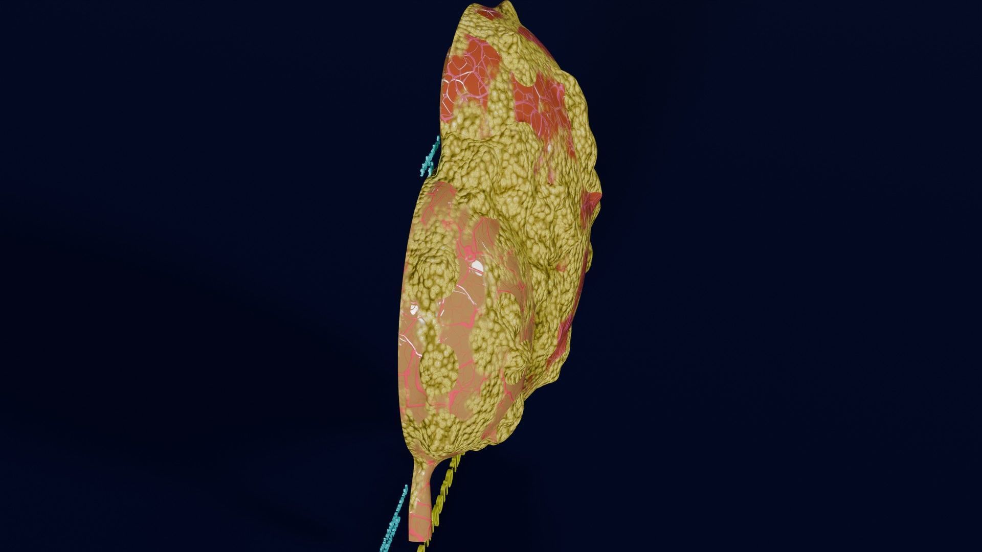 Hydronephrosis marked kidney renal Low-poly 3D model_55