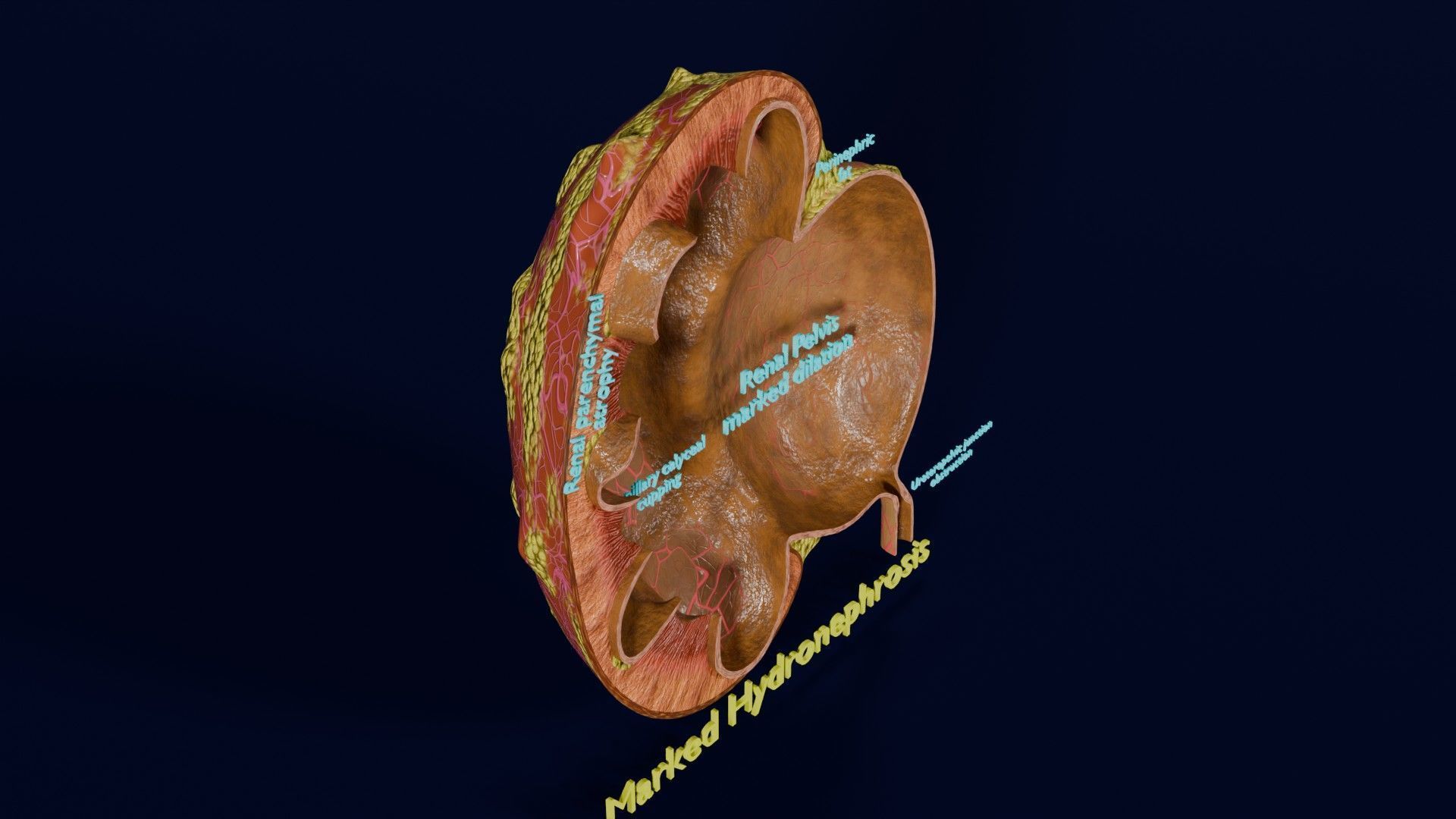 Hydronephrosis marked kidney renal Low-poly 3D model_27