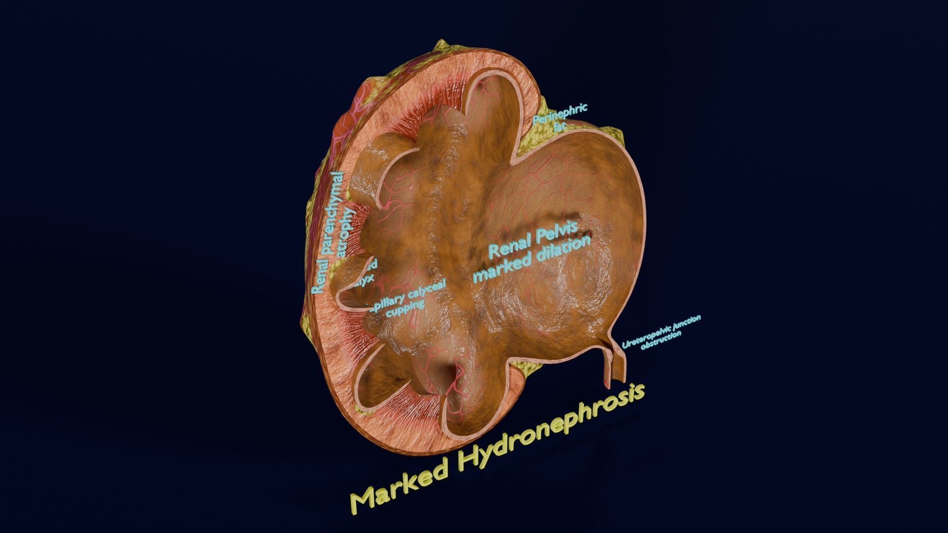 Hydronephrosis marked kidney renal Low-poly 3D model_23