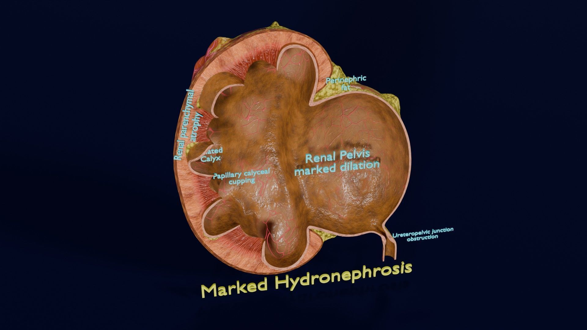 Hydronephrosis marked kidney renal Low-poly 3D model_22