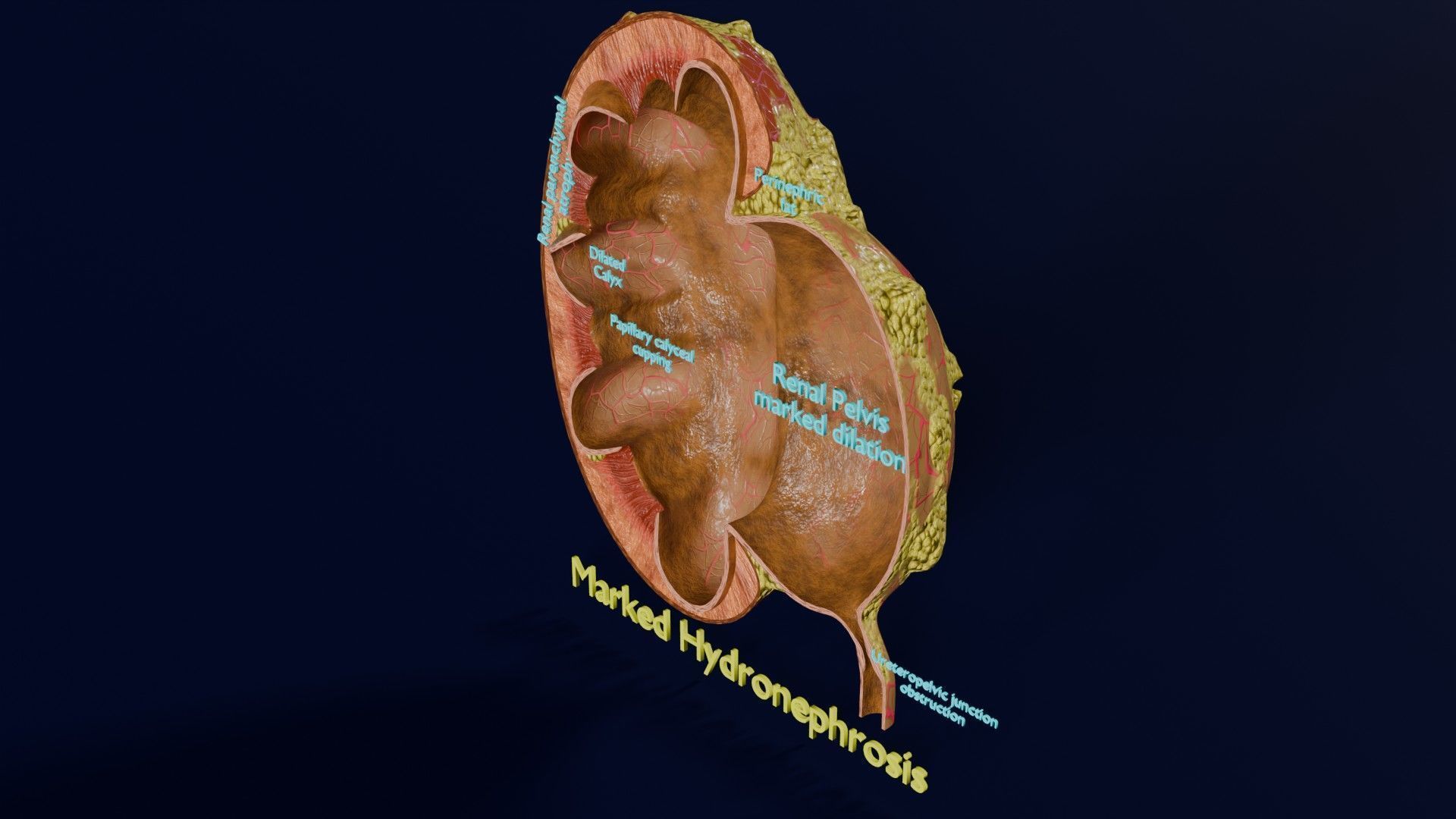 Hydronephrosis marked kidney renal Low-poly 3D model_2