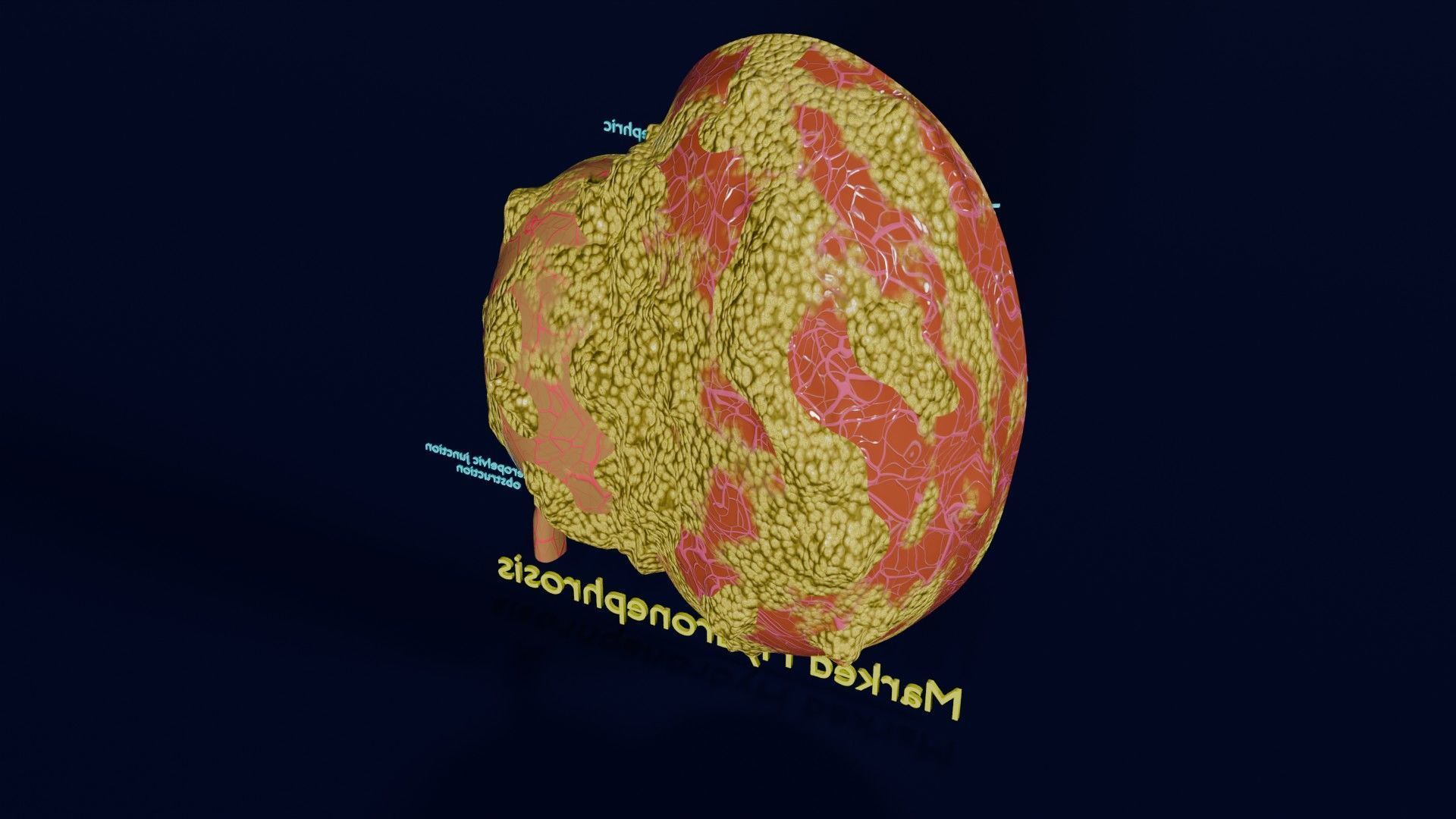 Hydronephrosis marked kidney renal Low-poly 3D model_34