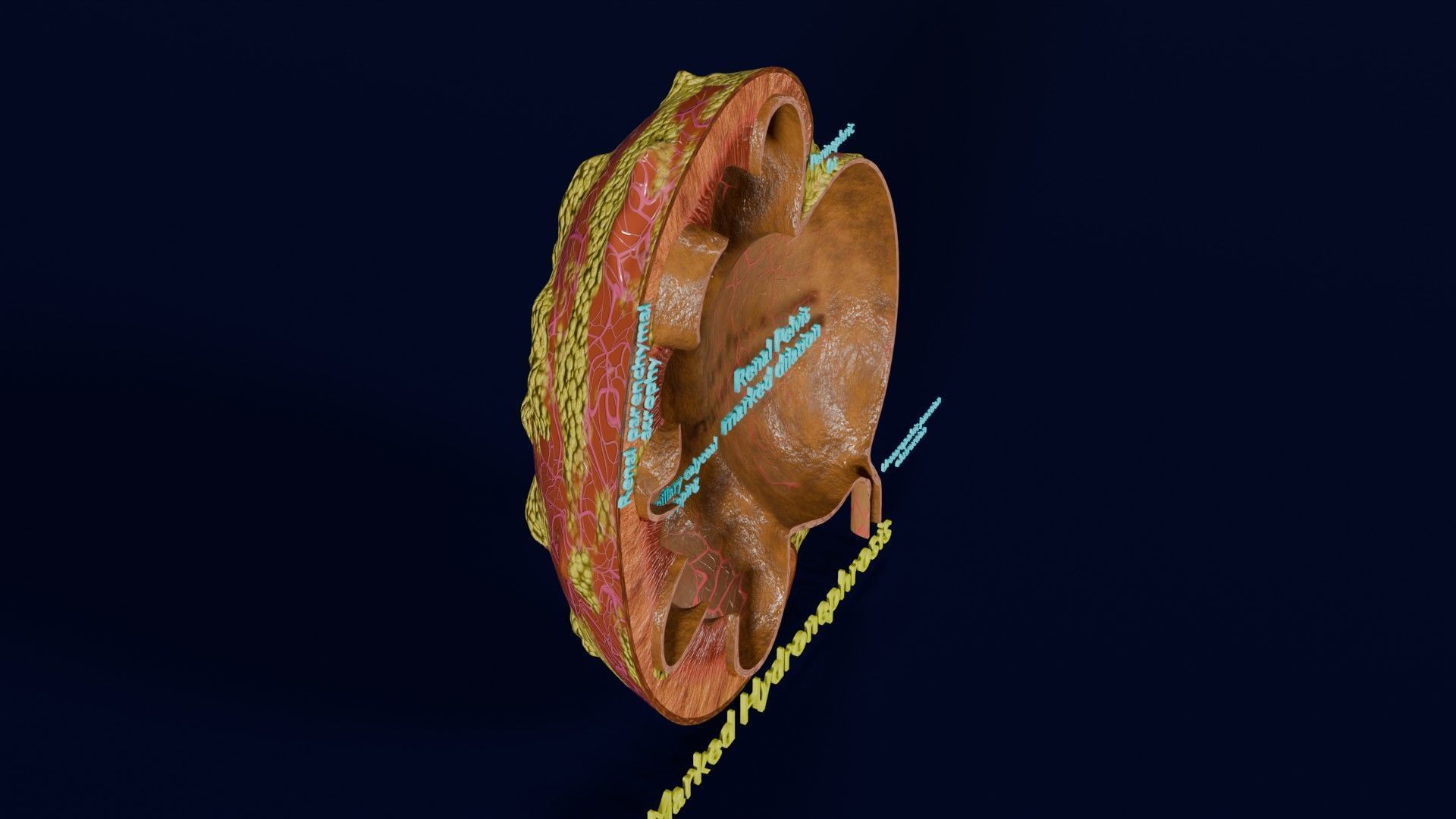 Hydronephrosis marked kidney renal Low-poly 3D model_28