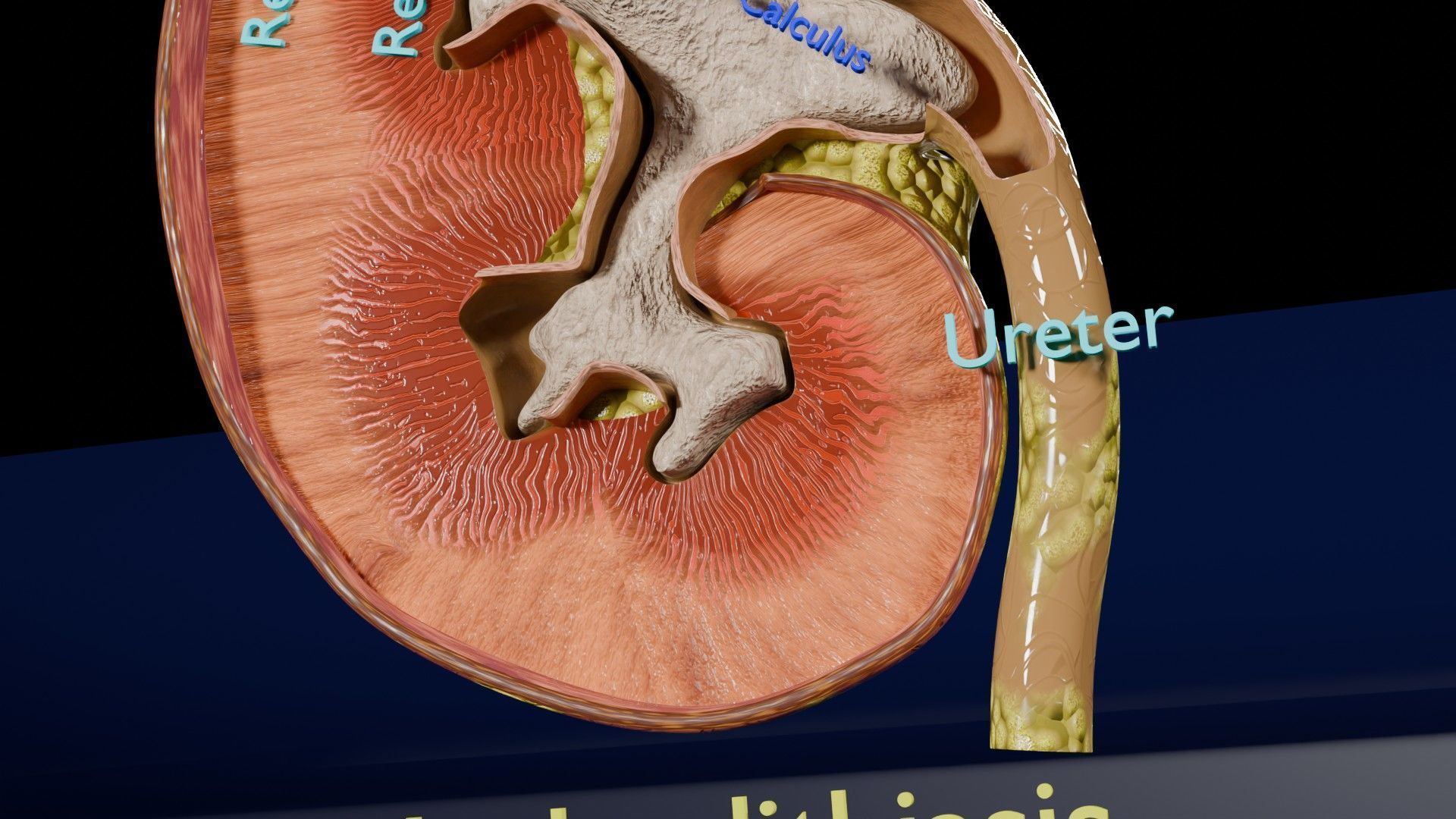 Kidney stone nephrolithiasis Staghorn calculus Low-poly 3D model_7