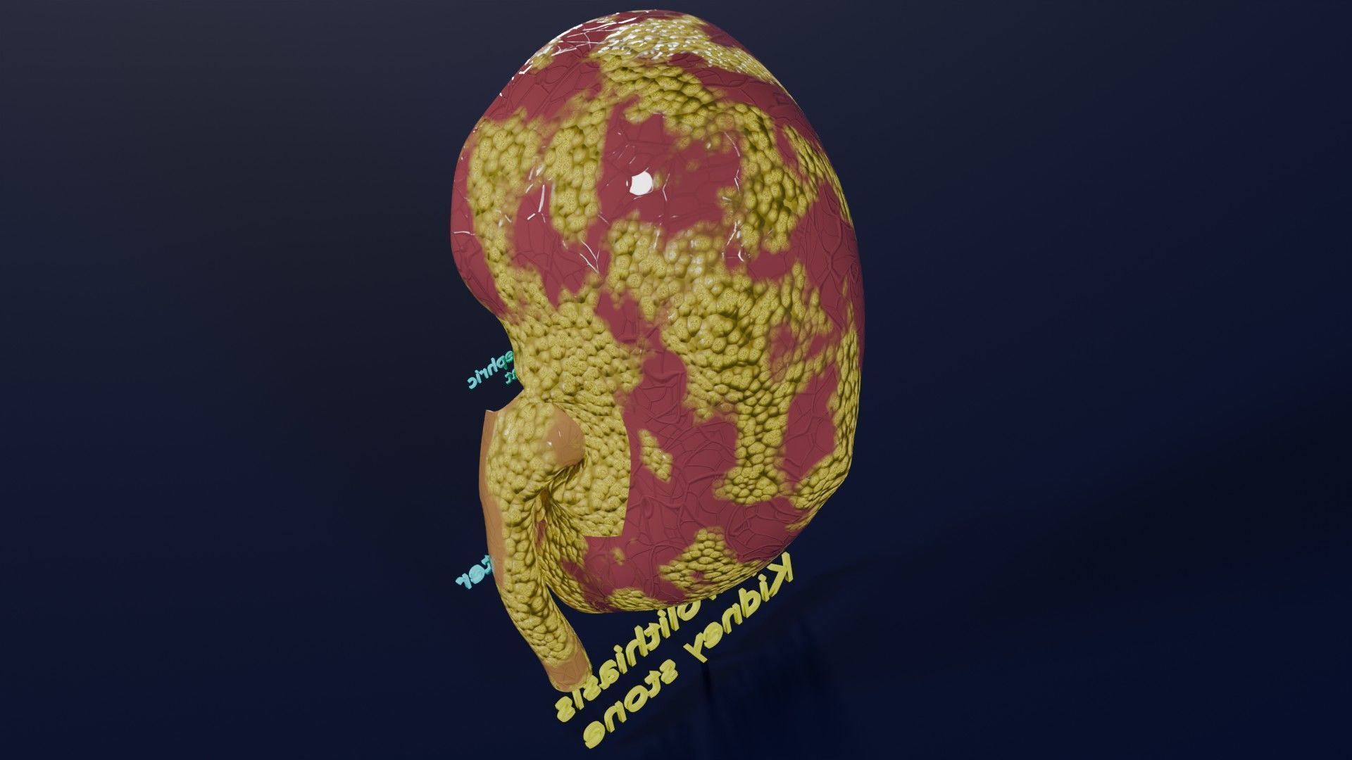 Kidney stone nephrolithiasis Staghorn calculus Low-poly 3D model_18