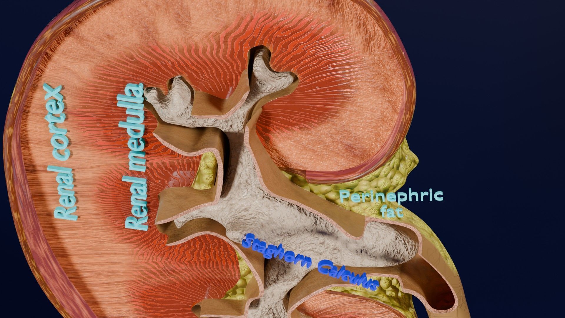 Kidney stone nephrolithiasis Staghorn calculus Low-poly 3D model_6