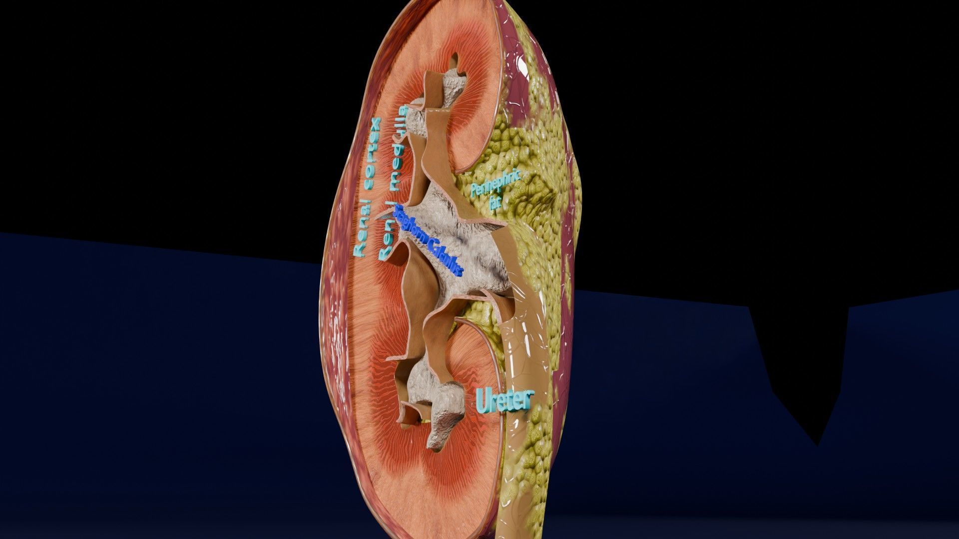 Kidney stone nephrolithiasis Staghorn calculus Low-poly 3D model_17