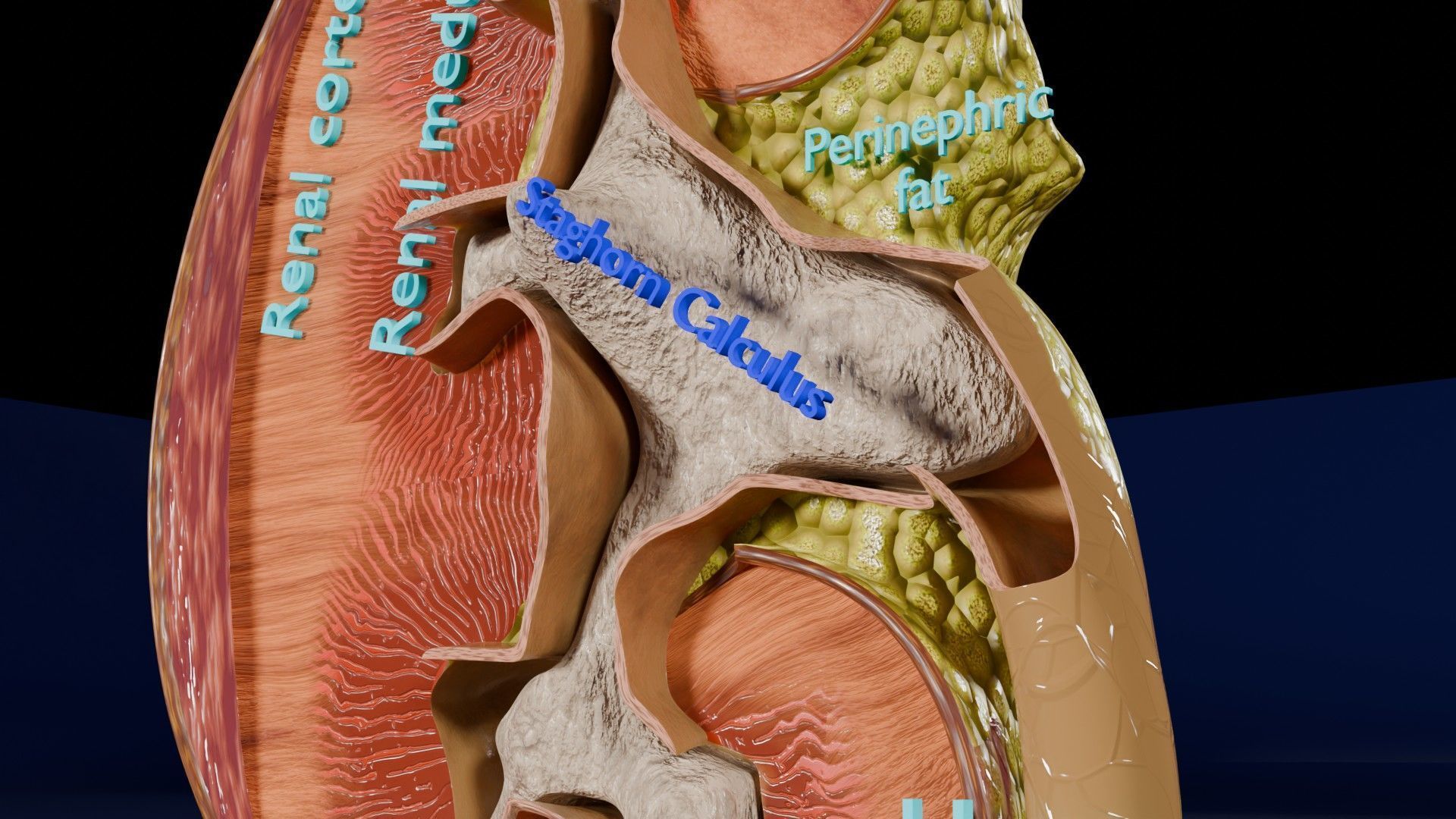 Kidney stone nephrolithiasis Staghorn calculus Low-poly 3D model_2
