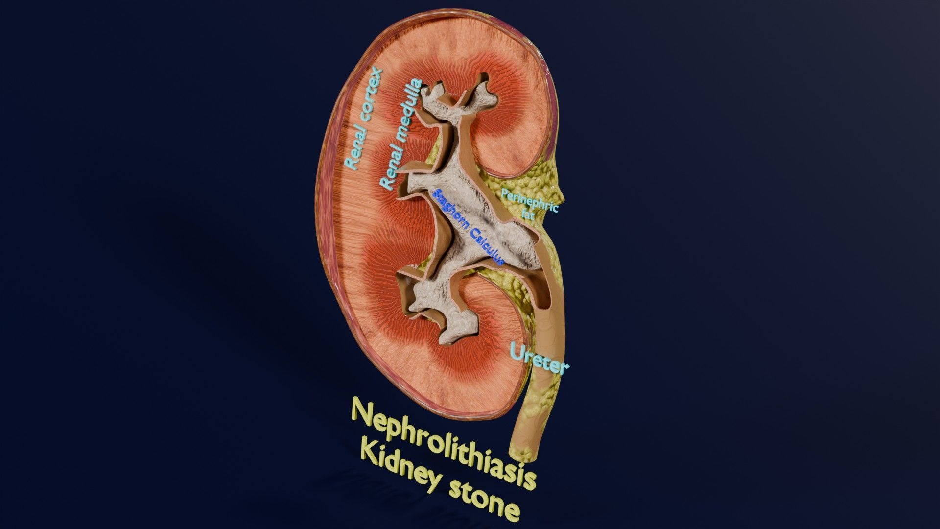 Kidney stone nephrolithiasis Staghorn calculus Low-poly 3D model_13