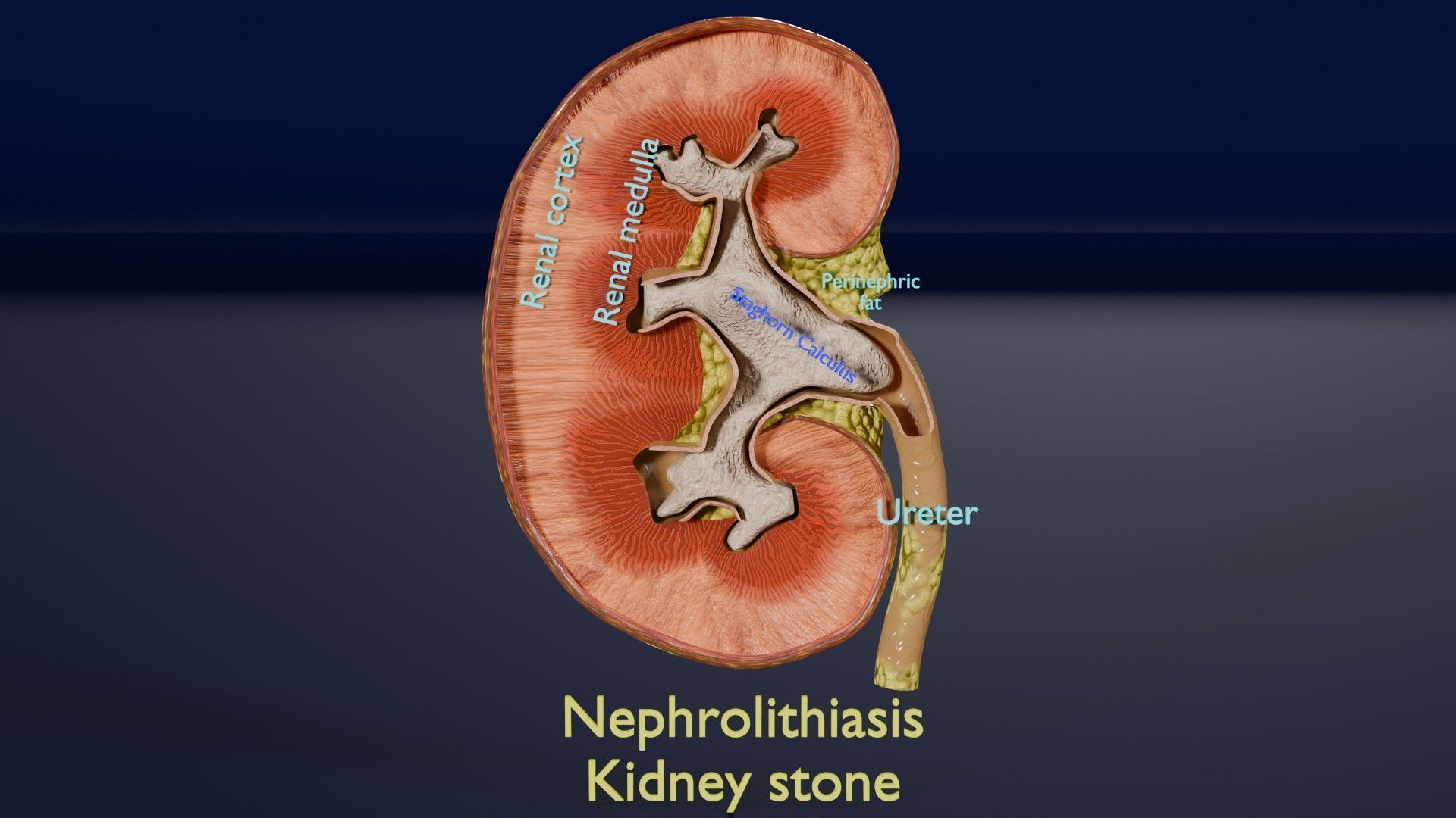 Kidney stone nephrolithiasis Staghorn calculus Low-poly 3D model_14