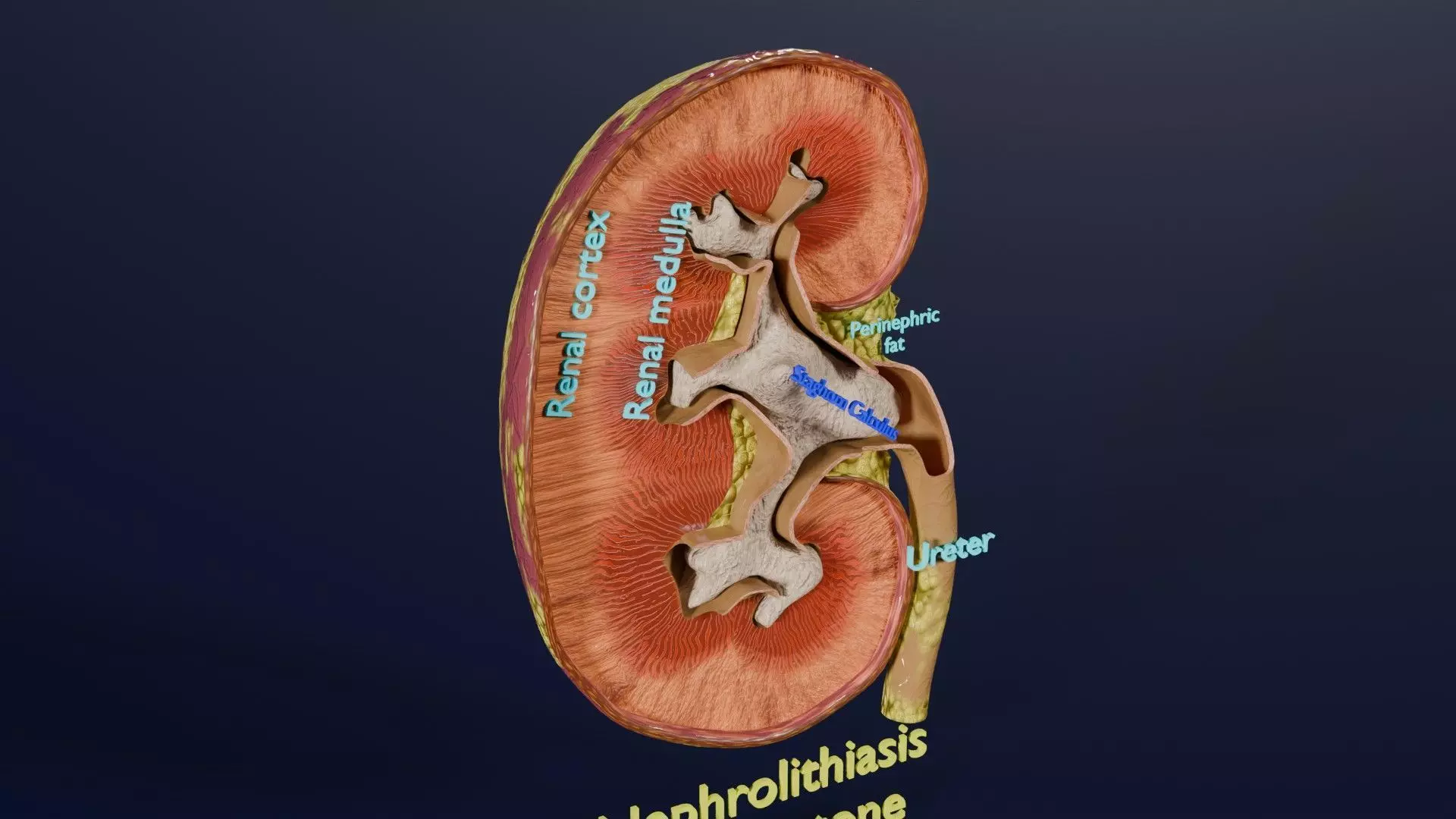 Kidney stone nephrolithiasis Staghorn calculus Low-poly 3D model_0