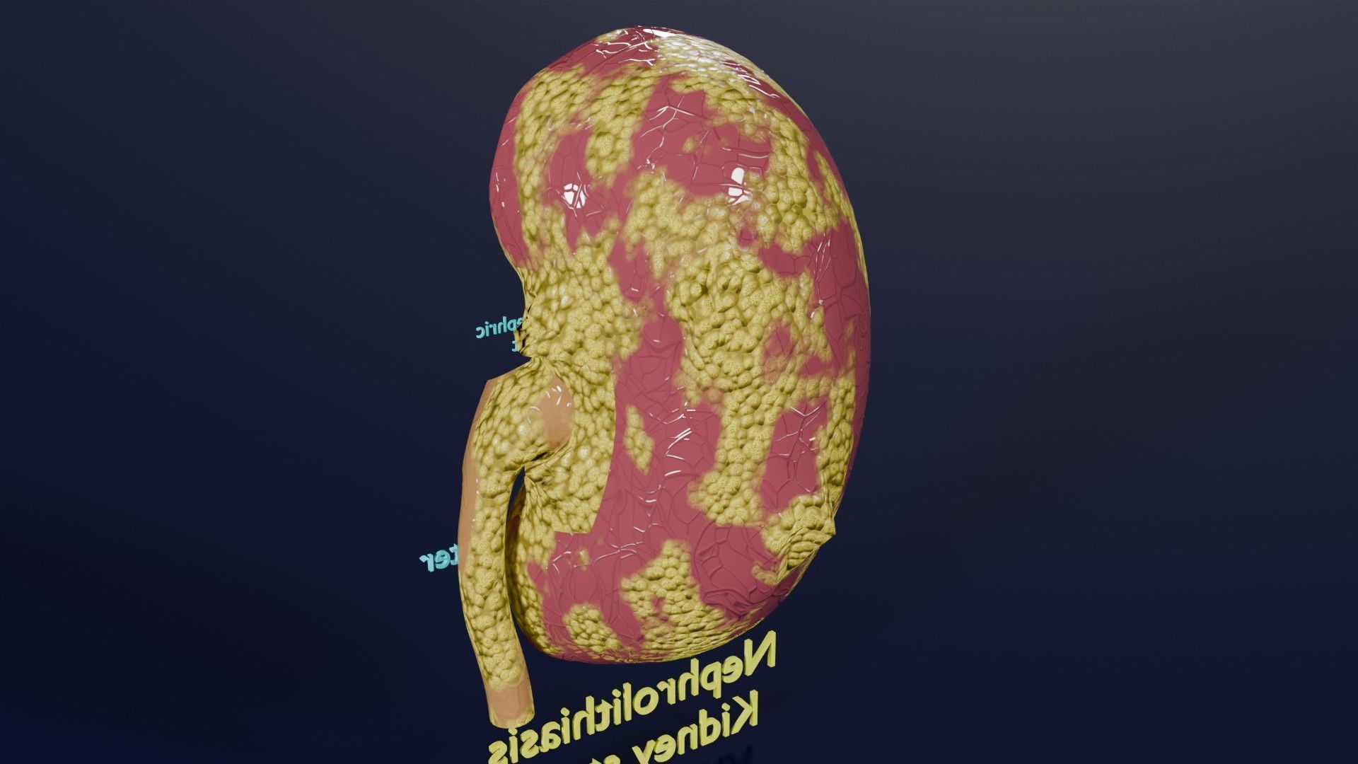 Kidney stone nephrolithiasis Staghorn calculus Low-poly 3D model_10