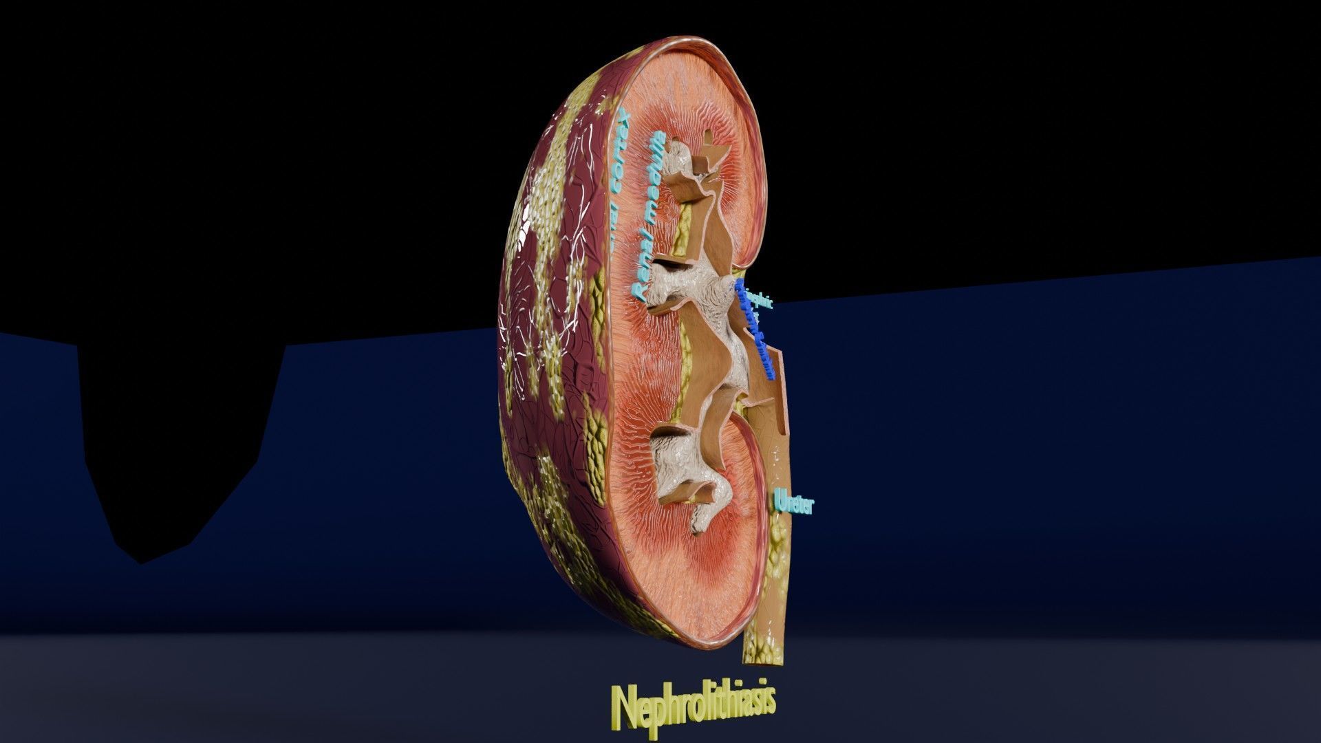 Kidney stone nephrolithiasis Staghorn calculus Low-poly 3D model_16