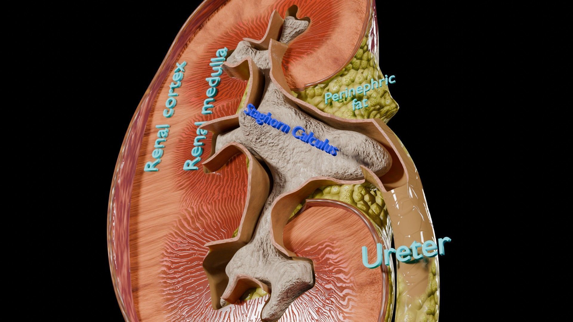 Kidney stone nephrolithiasis Staghorn calculus Low-poly 3D model_8
