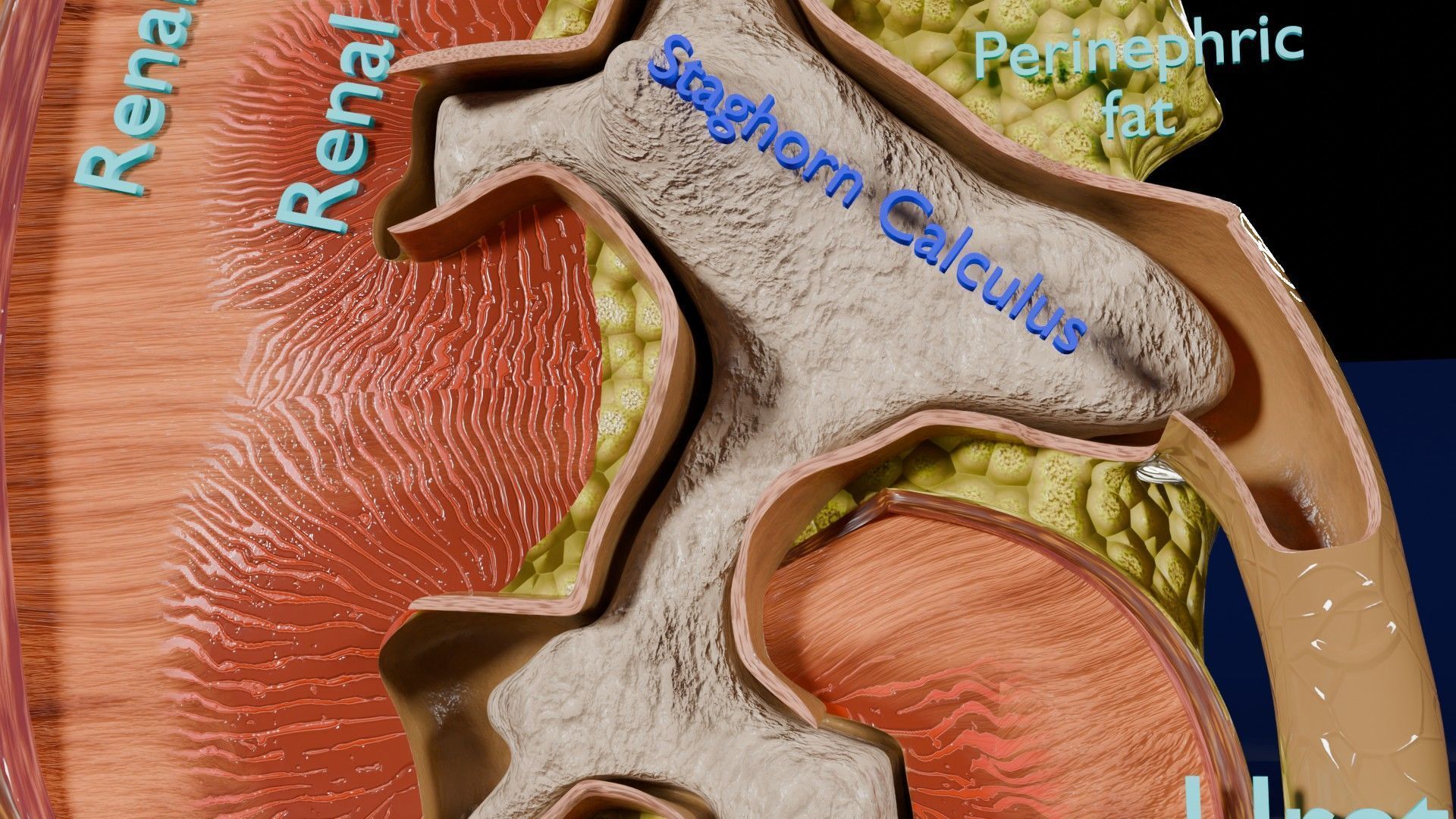 Kidney stone nephrolithiasis Staghorn calculus Low-poly 3D model_3
